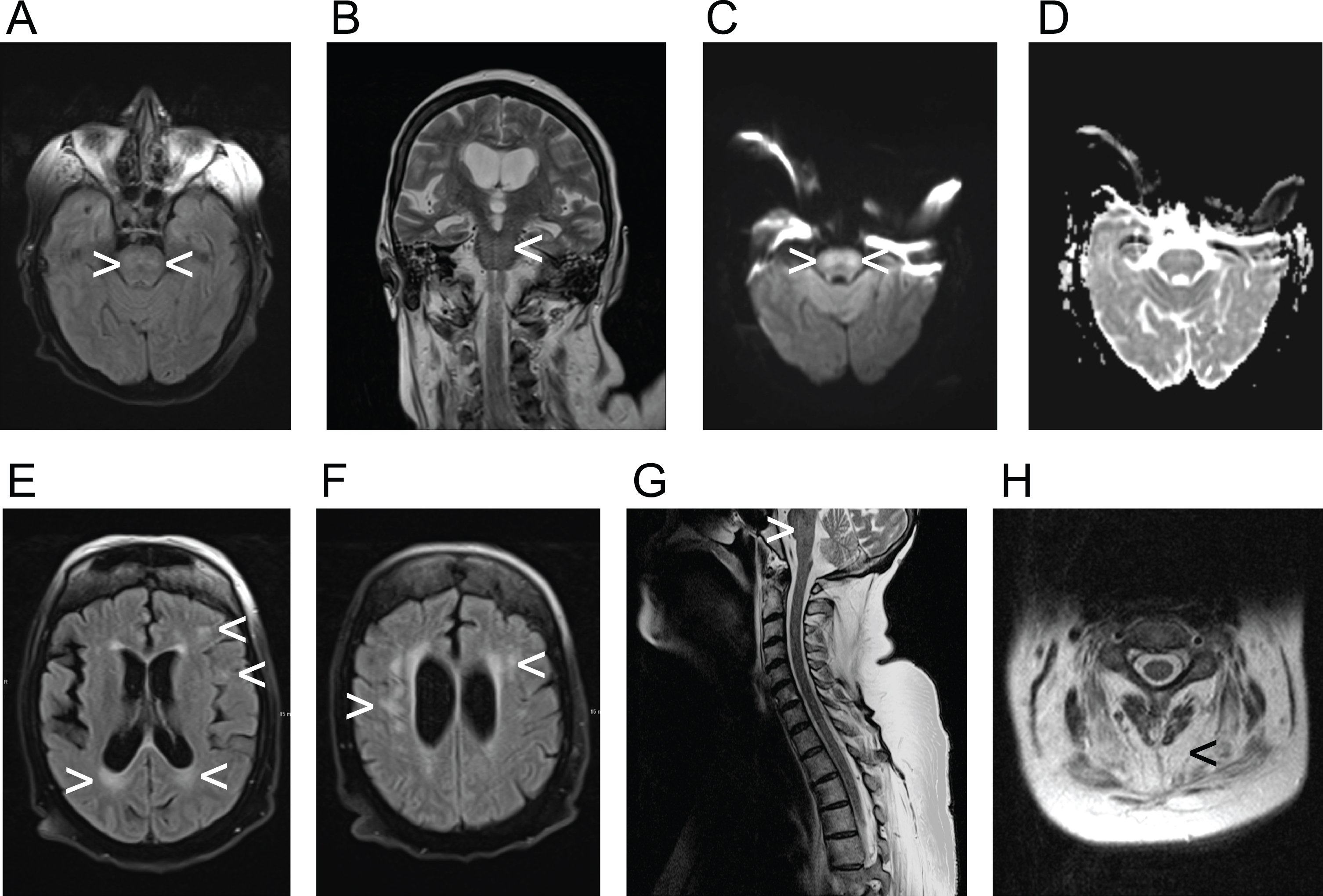 Demonstration of radiological findings in the patient, diagnosed with myotonic dystrophy type 1, utilizing various acquisition techniques. A) fluid-attenuated inversion recovery (FLAIR), axial view; B) coronal T2-weigthed image; C) axial view, diffusion-weighted magnetic resonance imaging (DWI); D) axial view, apparent diffusion coeffizient (ADC); E) and F) fluid-attenuated inversion recovery (FLAIR), axial views; G) T2-weigthed image, saggital view; H) T2-weigthed image, axial view with highlighted sign of muscular atrophy. Arrowheads are implemented to highlight pathologies exemplary. The participant provided an informed consent to publish health data including imaging data.