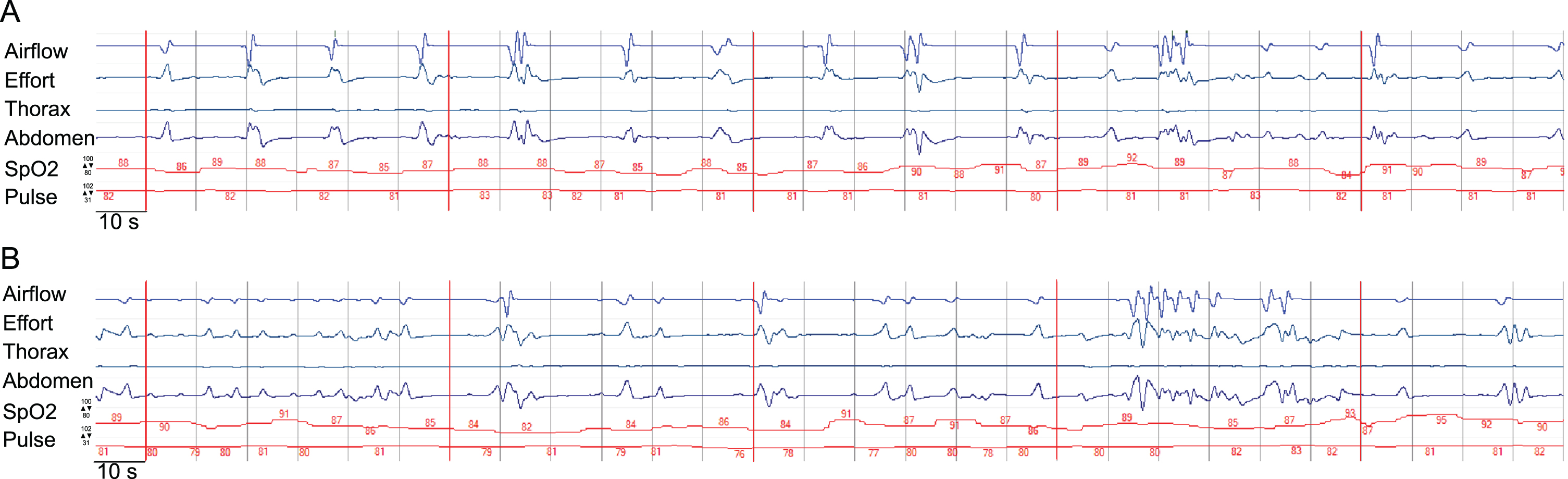 Display of an episode of the polygraphic recording showcasing central bradypnea. The time interval from one to another vertical line is 10s, the interval between two neighboring vertical red lines marks a 60s timeframe. The default range of the measurement of SpO2 and heart rate of the pictured measurement is given with respect to the upper and lower limit. SpO2 is displayed as a percentage, pulse as numbers of heart rate in beats per minute. The categories airflow, effort, thorax(-movement), abdomen(-movement) and activity are displayed in arbitrary units. Section a) demonstrates bradypnea and prolonged expiration, section b) demonstrates irregular variability of breathing effort and timing, consistent with ataxic (“Biot's”) breathing. The participant provided an informed consent to publish health data including polygraphic data.