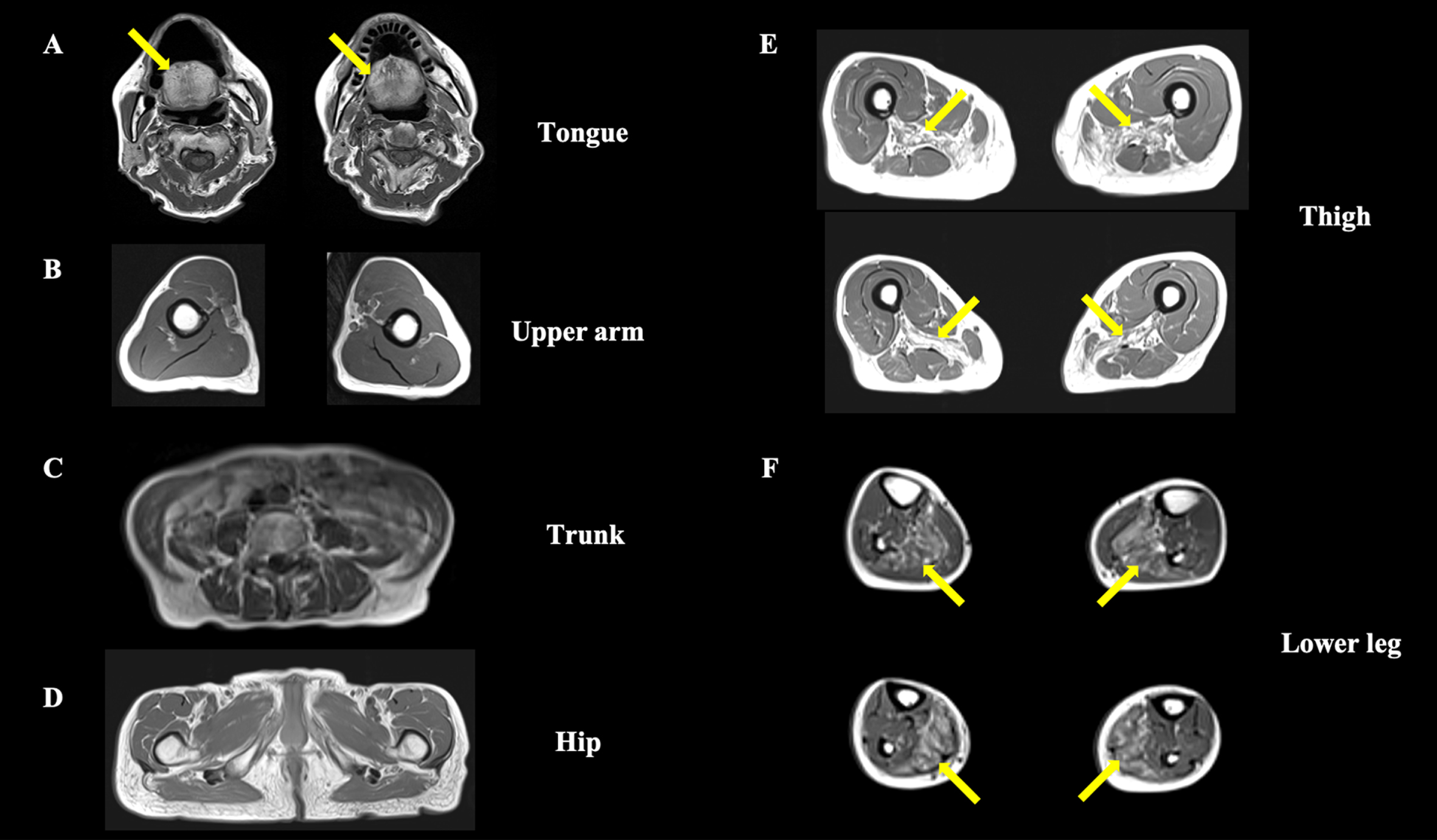 Axial T1-weighted muscle magnetic resonance imaging. (A) The tongue muscle tissue is replaced by fat (arrows), whereas other neck muscles are preserved. (B–D) The upper-arm, trunk, and hip region show no obvious muscle atrophy or fat replacement. (E) Bilateral adductor magnus muscle atrophy with fat replacement is observed at the thigh level (arrows). (F) The lower leg level shows bilateral soleus muscle fat replacement (arrows).
