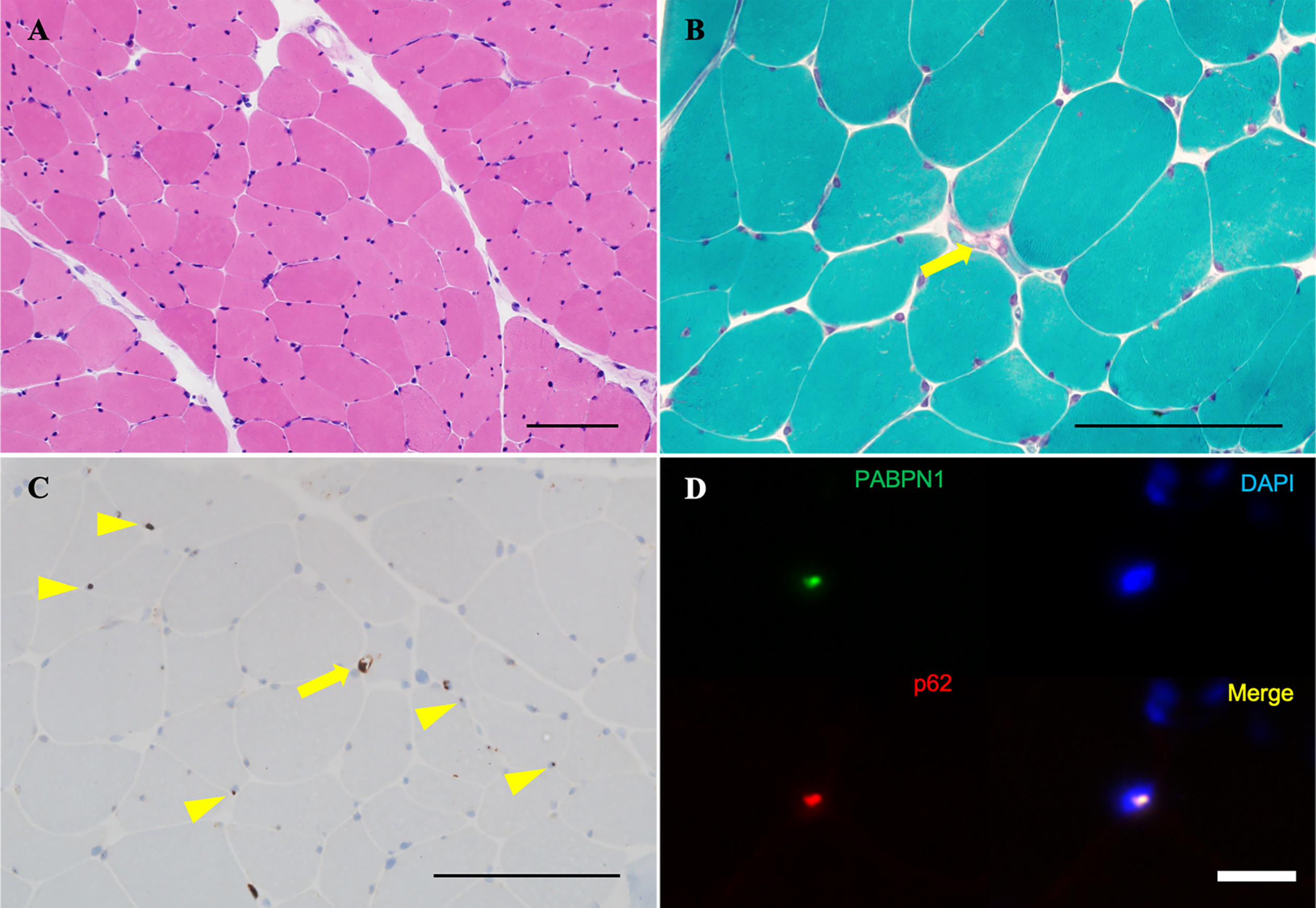 Biopsy sample of the left rectus femoris. (A) Variable myofiber size and the absence of inflammatory cells, necrotic fibers, or regenerating fibers are observed on H&E. (B) On modified Gömöri trichrome staining, rimmed vacuoles are observed in only one fiber (arrow). (C) Intracytoplasmic accumulation of p62 aggregates are observed in only one fiber (arrow), along with some p62-positive intranuclear inclusions on immunohistochemistry (arrowheads). (D) Nuclear accumulation of insoluble PABPN1 is highlighted by anti-PABPN1 antibody in immunohistochemistry (arrows). Scale bars: 100μm.