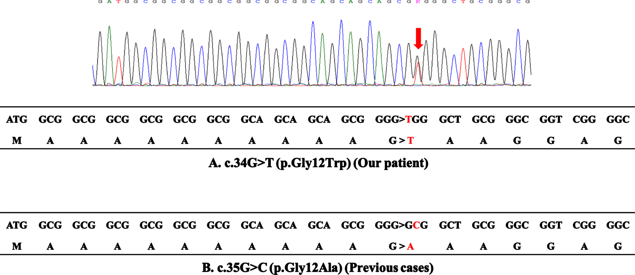 DNA sequence analysis. (A) The upper panel reports the sequence trace of the patient, indicating the position of the c.34G > T base change (arrow). The lower panel reports the coding sequence of the first 18 codons in exon 1 of the PABPN1 gene of the patient. The c.34G > T mutation results in the substitution of glycine by tryptophan at codon 12, which does not cause expansion of polyalanine stretch. (B) The coding sequence of the 4 reported cases with the c.35G > C mutation. The c.35G > C mutation results in the substitution of glycine by alanine at codon 12, which generates a sequence of 13 contiguous alanines.
