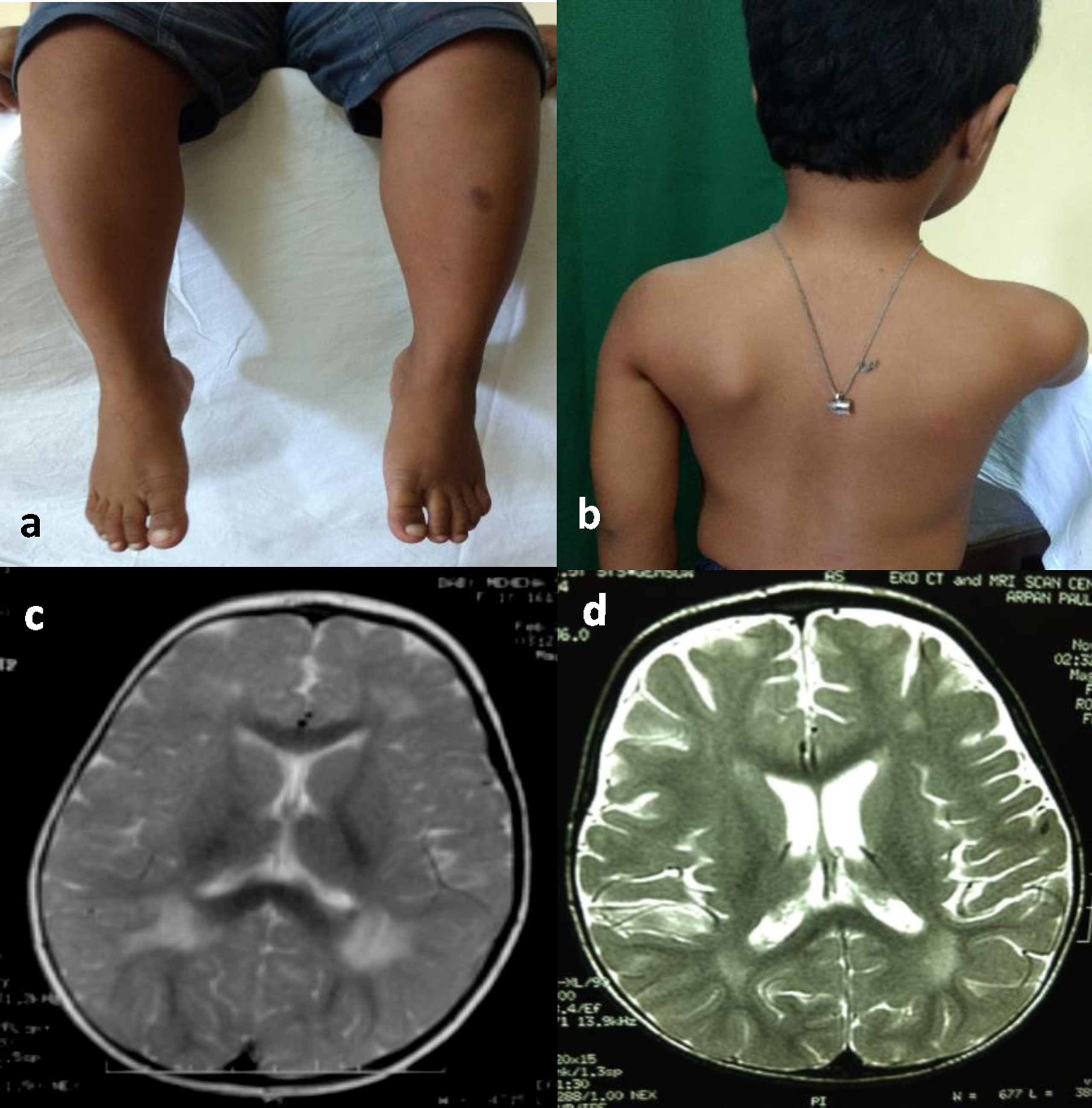 Clinical photographs and MRI images of patients with congenital muscular dystrophy phenotype. a and b: Calf muscle hypertrophy and scapular winging in patient 2 with congenital muscular dystrophy phenotype c and d: Brain MRI showing periventricular white matter T2 hyperintensities in patient 9 (figure c) and patient 2 (figure d) with congenital muscular dystrophy phenotype.