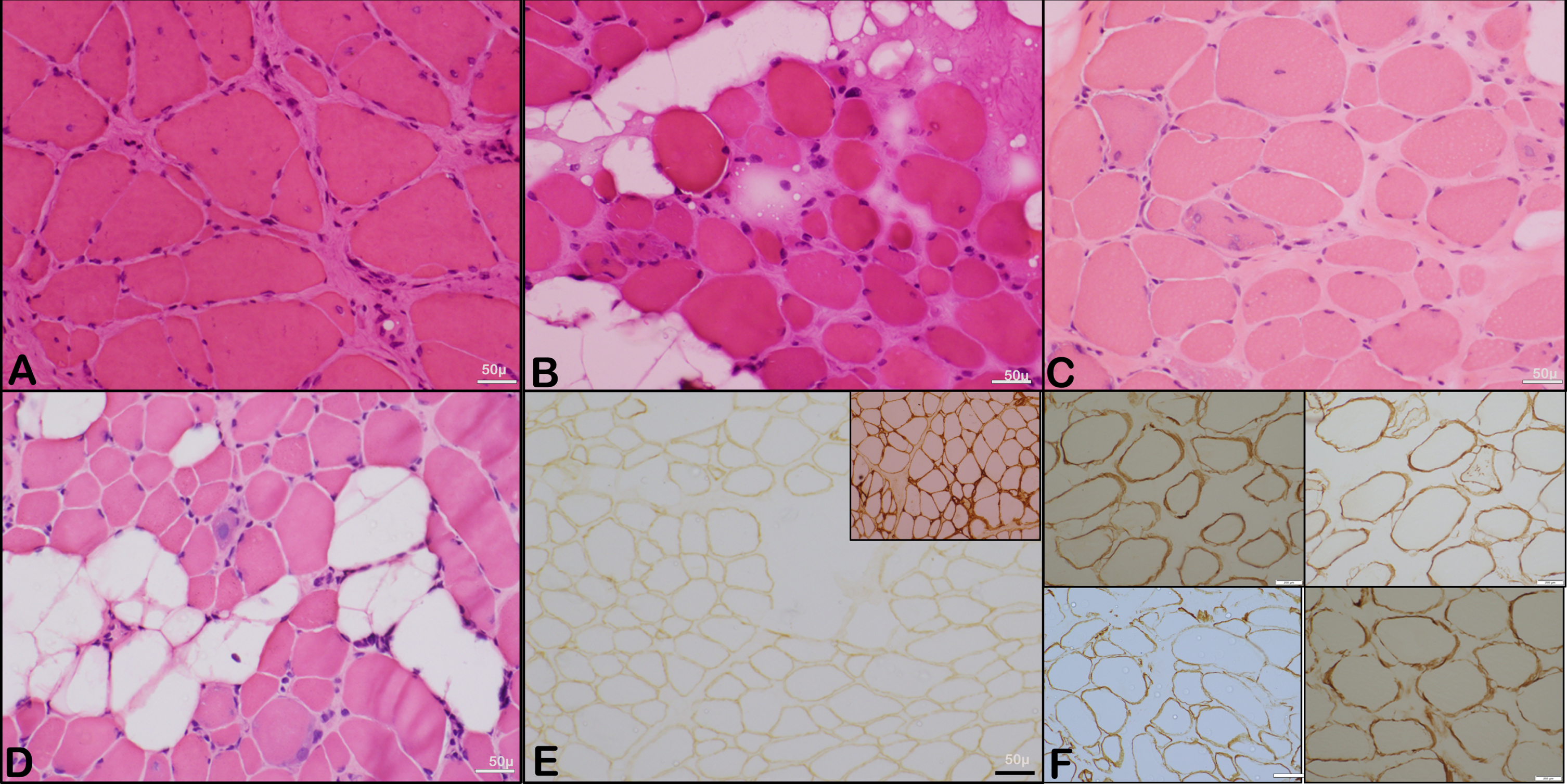 Representative microphotographs showing the histopathological changes. A to D: Representative microphotographs showing variation in fibre size with variable atrophic and scattered hypertrophic fibres with regenerating fibres and evidence of interstitial (endomysial) fibrosis (Transverse section, H & E, X 200). E: Microphotograph showing muscle fibres with reduced expression of merosin (Inset shows control staining) (IHC, X 200). The perimysium is thickened and endomysial fibrosis is observed. F: Representative images of muscle immunohistochemistry (Alpha, Beta, Gamma and Delta Sarcoglycan; IHC x 200).