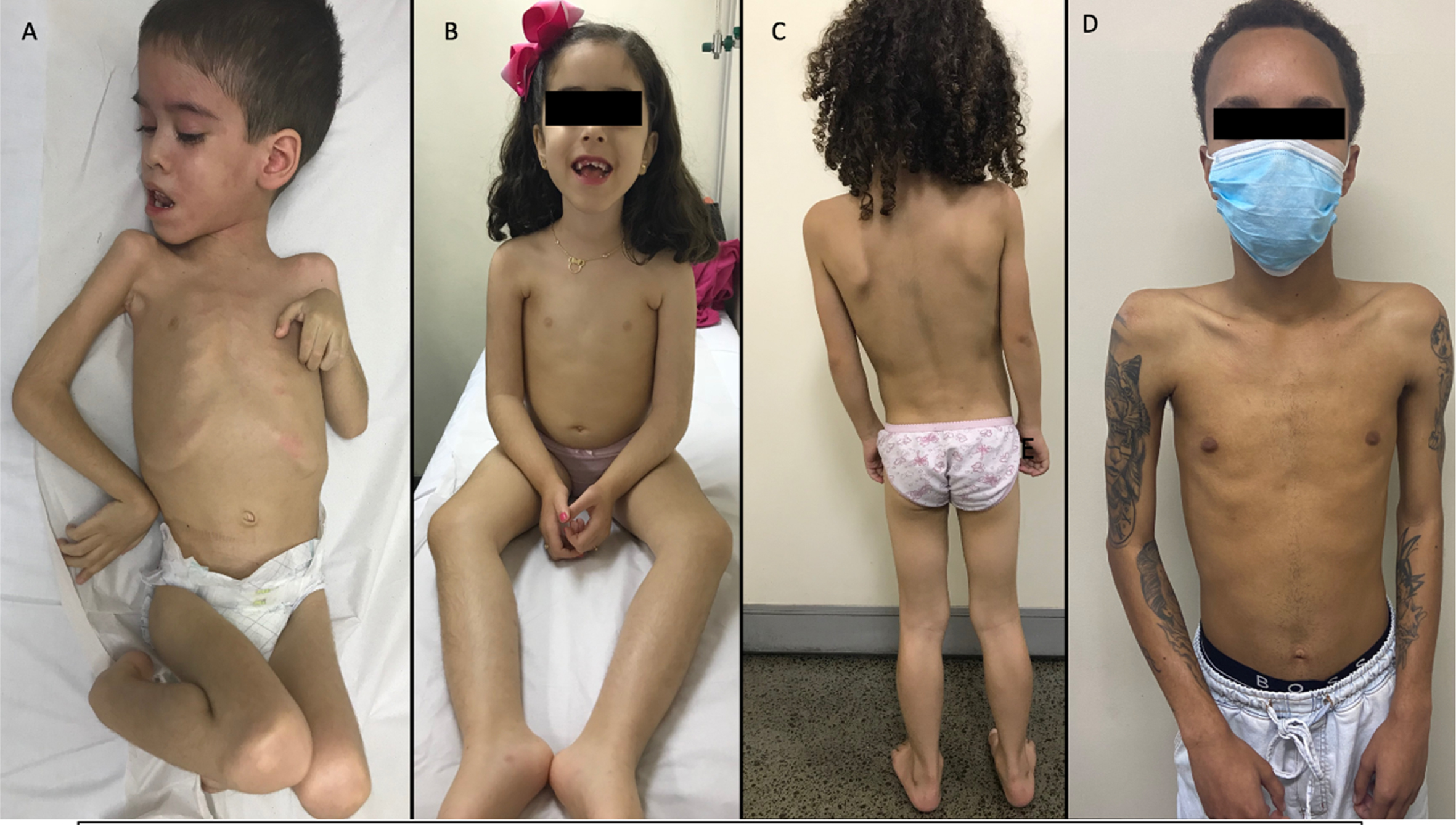 LAMA2-RD phenotypes. (A) Patient never able to sit, (B) Patient able to sit, but unable to walk, (C) Patient able to walk, with delayed motor development, and (D) Patient able to walk with LGMD phenotype.