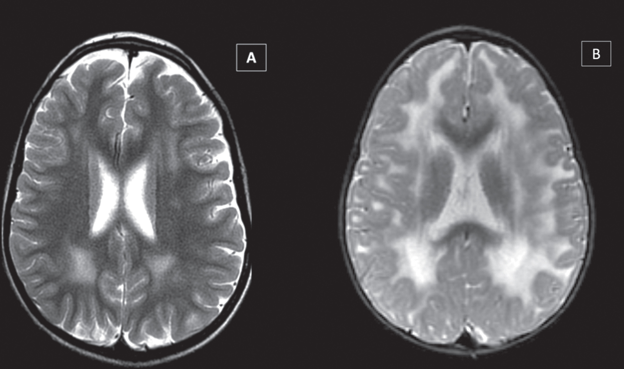 White Matter abnormalities in LAMA2-RD, showing variable involvement of periventricular, central, and subcortical white matter regions on brain MRI, according to motor function - greater involvement in most severe motor phenotype. Patient able to walk (A – T2-WI), unable to walk (B – T2-WI), and unable to sit (C - FLAIR).