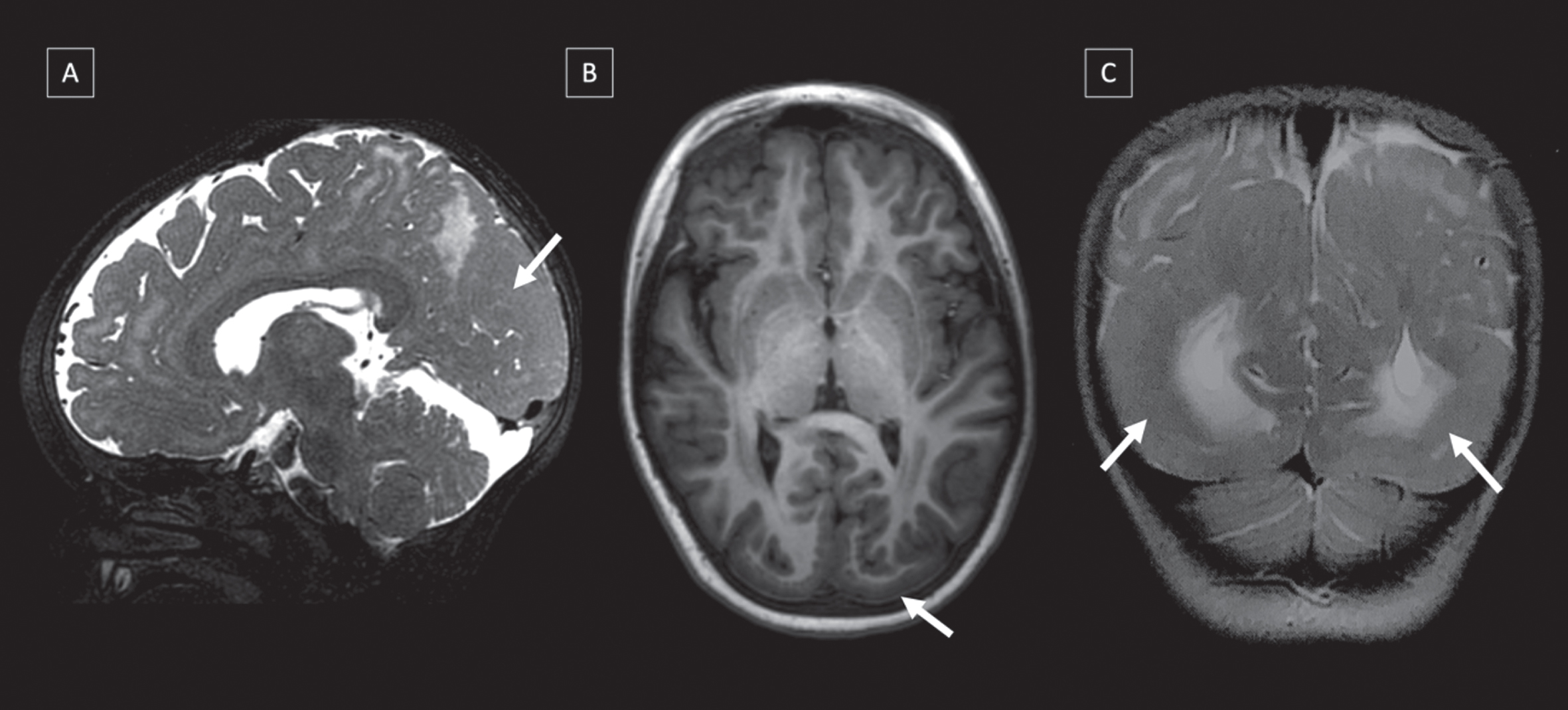 Brain malformations in three different CMD-LAMA2 patients MRI’s: (A) Lissencephaly-pachygyria in occipital lobe (T2-WI), (B) Polymicrogyria and cobblestone in occipital lobe in (T1-WI), and (C) Pachygyria in occipital and temporal lobes in (T2-WI).