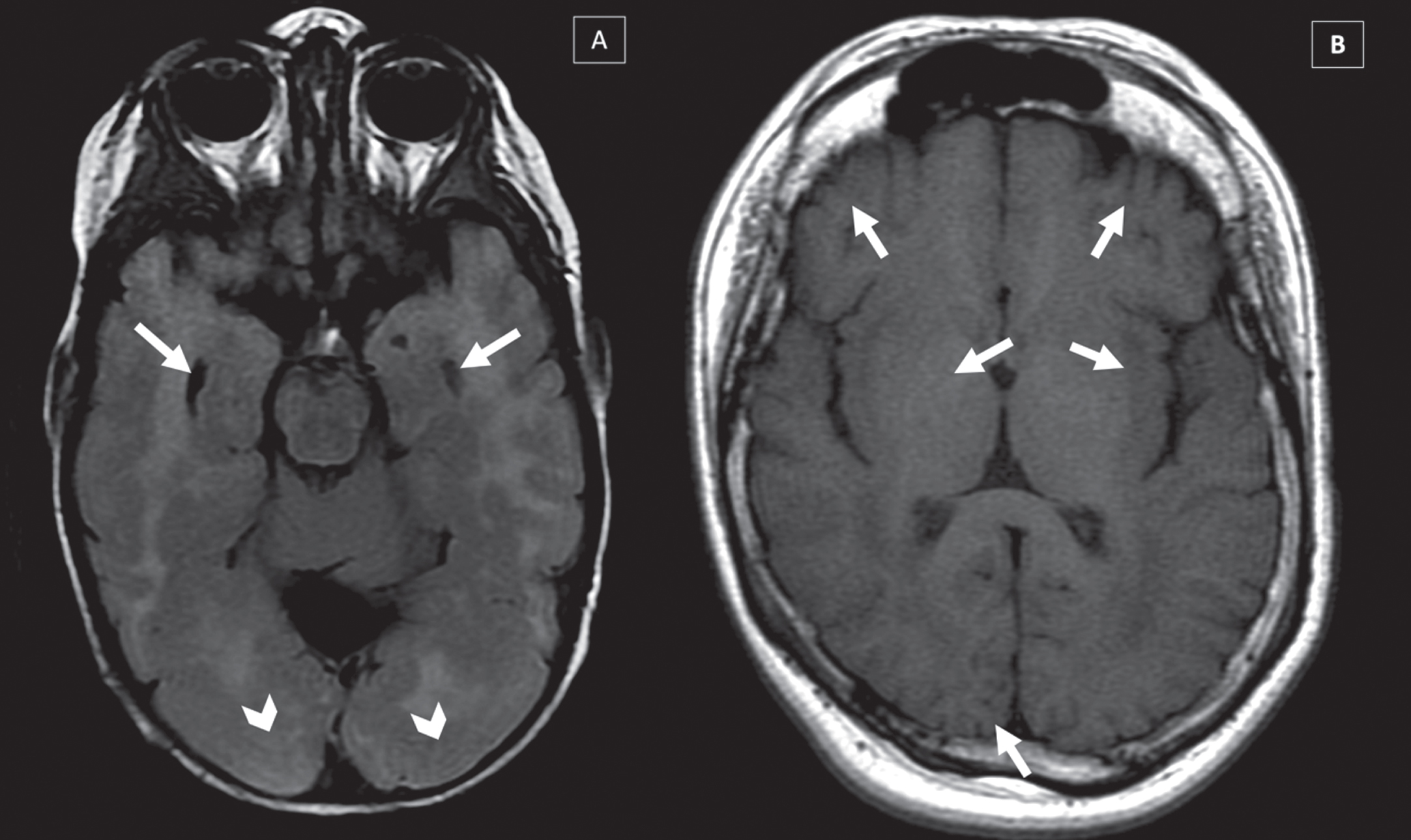 Brain malformations in two different CMD-LAMA2 patients MRI’s: (A) Lissencephaly-pachygyria in occipital lobe (arrows head) and temporal cists (arrows) (T2-WI), (B) Polymicrogyria in frontal, temporal and occipital lobes in (T1-WI) (arrows).