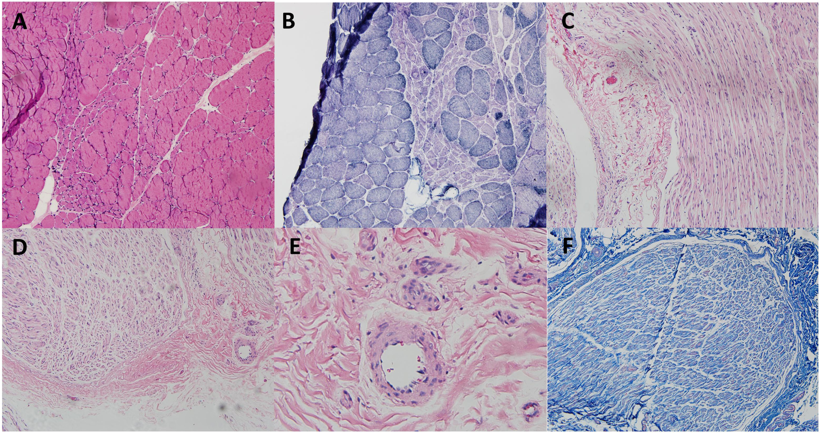 Combined muscle and nerve biopsy in patient 31. The staining of hematoxylin and eosin (H&E) (A) and nicotinamide adenine dinucleotide-tetrazolium reductase (B) showed grouped atrophy in the right peroneal brevis muscle. The biopsy in the right superficial peroneal nerve did not show thickening of small vessels, lymphocyte infiltration, red blood cell extravasation in H&E (C-E) and Masson’s trichrome staining (F).