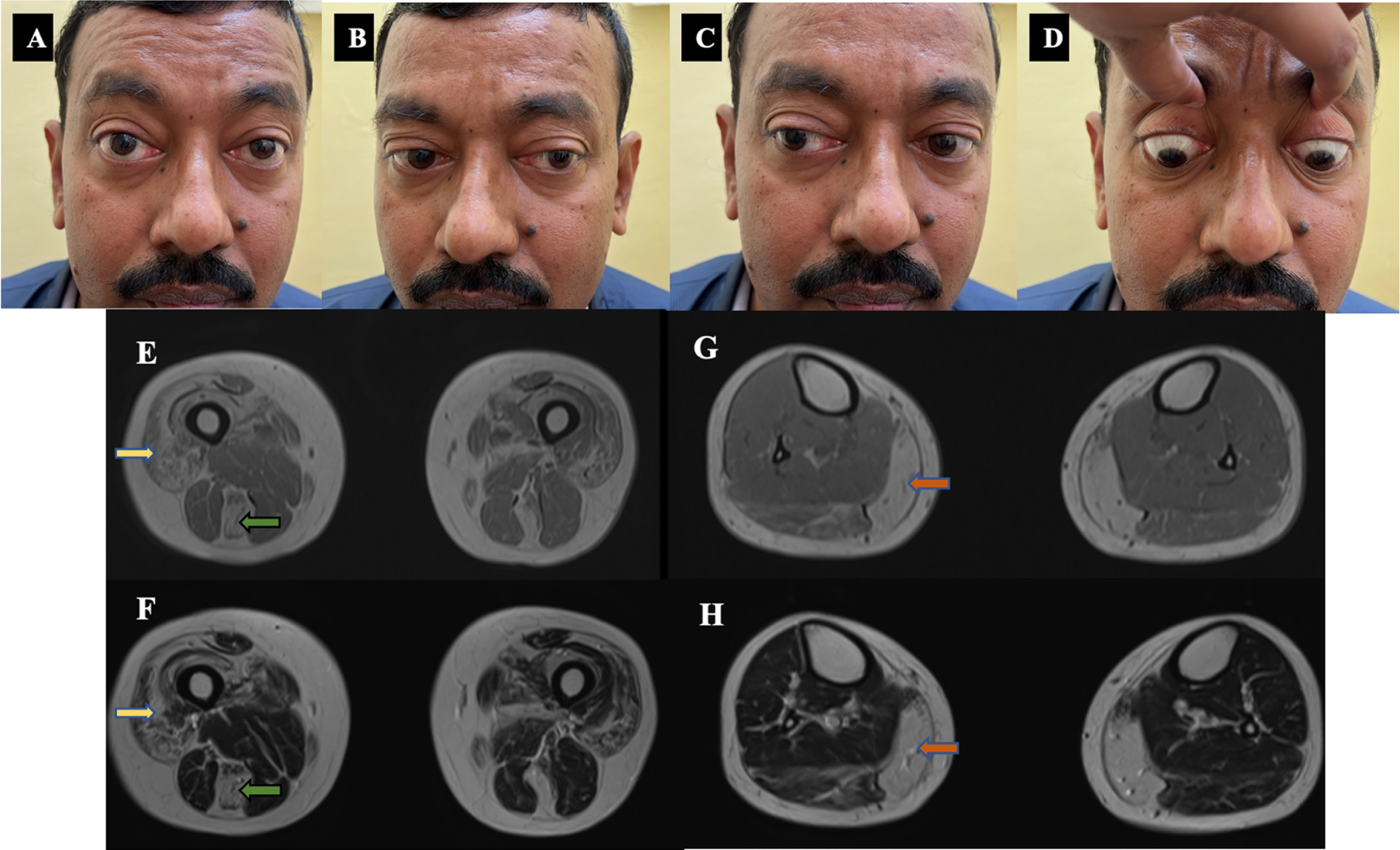 Clinical images and MRI muscle of patient –1. A, B, C, D: Clinical images - Ocular motility restriction - Abduction and upgaze restriction with proptosis. E, F, G, H: Muscle MRI images - E- T1 W, F-T2 W images showing quadriceps (yellow arrow), semitendinosus (green arrow) fatty infiltration. G-T1 W, H-T2 W images showing predominant medial gastrocnemius (orange arrow) fatty infiltration with sparing of anterior leg muscles.