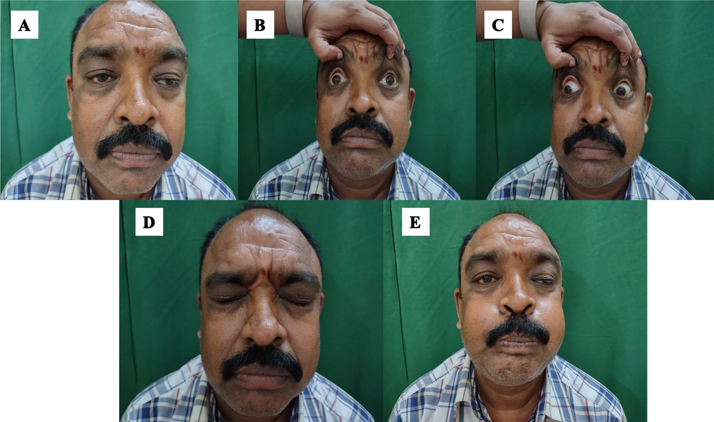 A, B, C, D: Clinical images of patient-2. A –Asymmetric ptosis. B, C- Restricted ocular motility. D,E –Facial weakness.