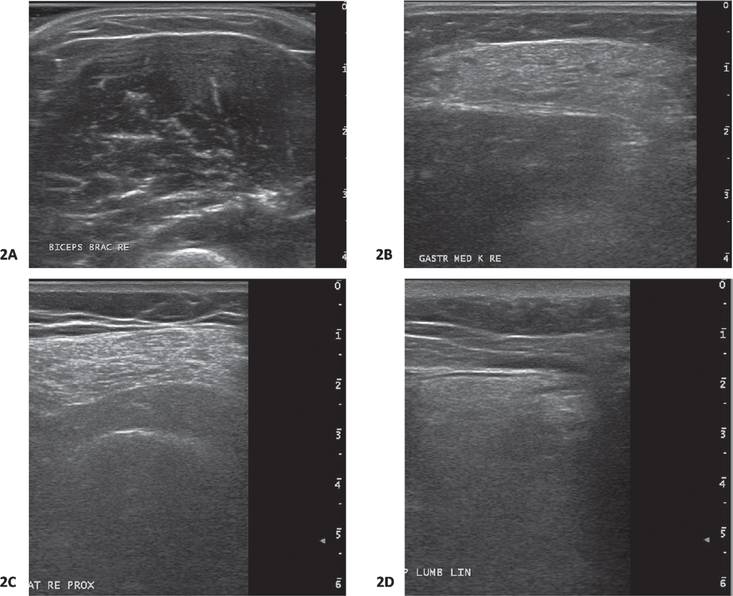 Muscle ultrasound images from participants. 2A: Biceps brachii muscle ultrasound image from a participants with late-onset proximal muscle weakness. This muscle ultrasound image shows normal echogenicity (Heckmatt rating scale(22) 1; z-score –3.7). The z-score for muscle thickness was 1.5. This participants carries the RYR1 c.12226C>T, p.Phe4076Leu variant. 2B: Gastrocnemius muscle ultrasound image from a participant with late-onset proximal muscle weakness. This muscle ultrasound image shows increased echogenicity (Heckmatt rating scale 3;(22) z-score 4.0). The z-score for muscle thickness was –1.2. This participants carries the RYR1 c.10616G>A, p.Arg3539His variant. This gastrocnemius muscle ultrasound image is from the same participant whose proximal vastus lateralis muscle ultrasound image is shown in Fig. 2C. 2C: Proximal vastus lateralis muscle ultrasound image from a participant with late-onset proximal muscle weakness. This muscle ultrasound image shows an increased echogenicity (Heckmatt rating scale 3;(22) z-score 7.4). The z-score for muscle thickness was –1.5. This participants carries the RYR1 c.10616G>A, p.Arg3539His variant. This proximal vastus lateralis muscle ultrasound image is from the same participant whose gastrocnemius muscle ultrasound image is shown in Fig. 2B. 2D: Paraspinal lumbar muscle ultrasound image from a participant with symptoms of cramps and myalgia. This muscle ultrasound image shows an increased echogenicity (Heckmatt rating scale 3;(22) z-score 3.1). The z-score for muscle thickness was –1.5. This participants carries the RYR1 c.1021G>A, Gly341Arg variant.