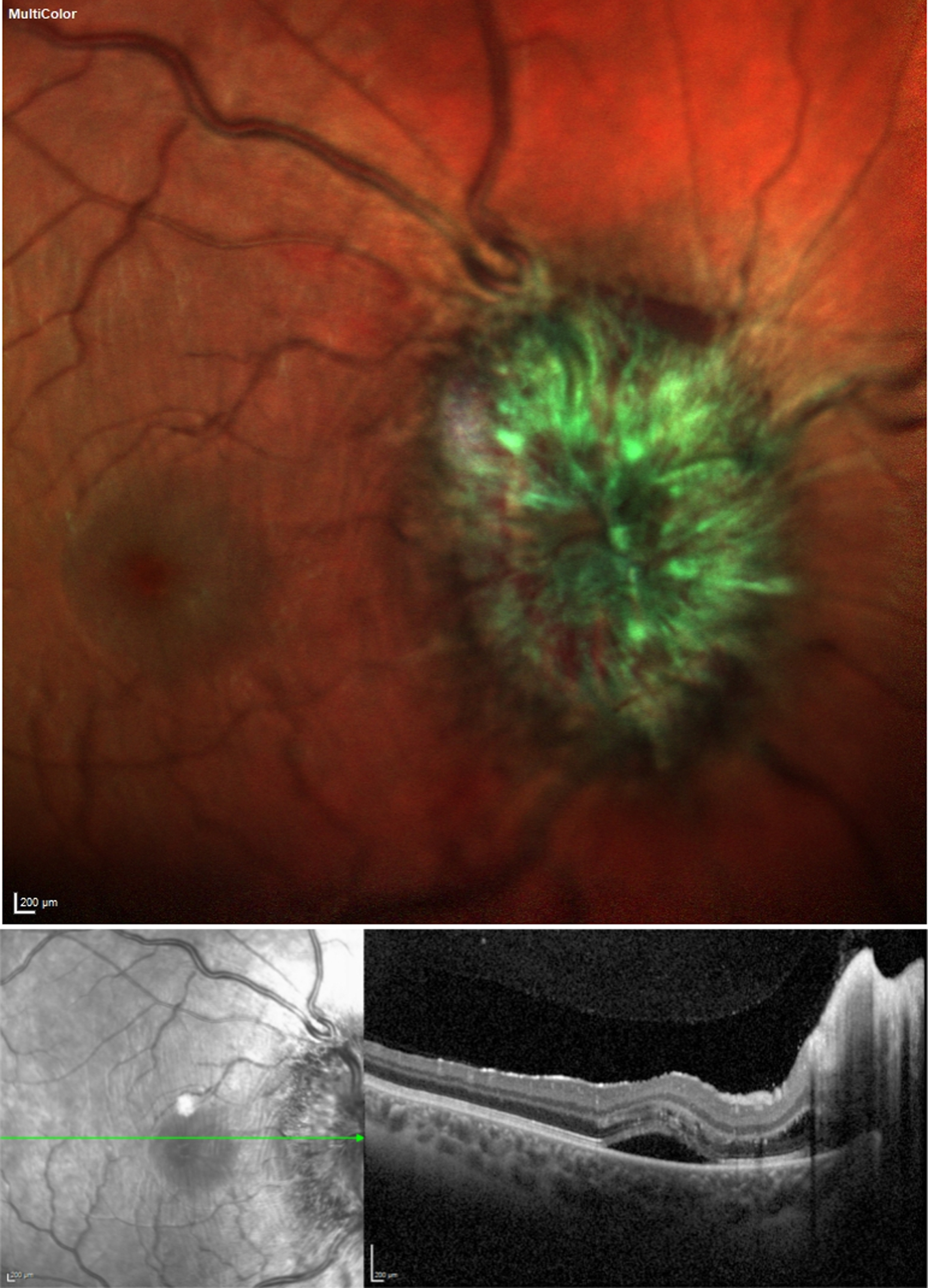 Multicolor imaging (color figure available in the electronic version) showing papilledema with hemorrhage and optical coherence tomography (OCT) showing papilledema with secondary macular edema. Written permission to publish these images was granted by the patient.