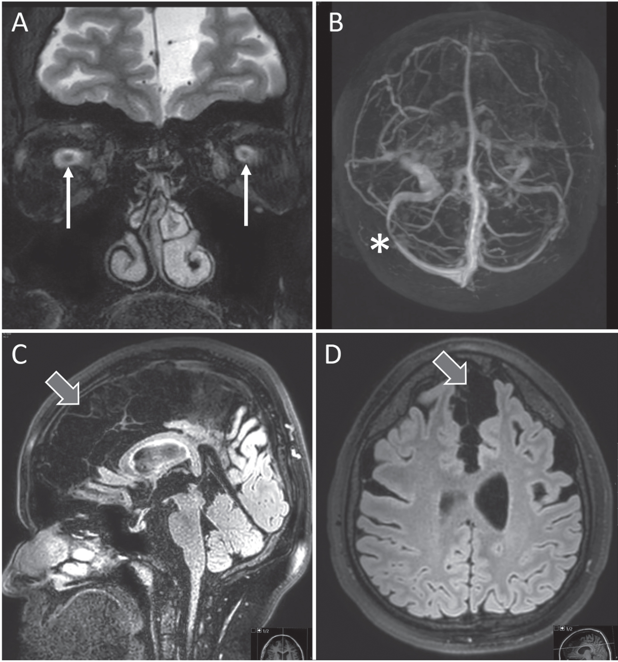 MRI showing classic signs of intracranial hypertension with prominent optic discs (arrows in A), sinus stenosis (asterisk in B) and flattening of pituitary gland (C). Note extensive subarachnoid cysts with local space-occupying appearance (block arrows in C and D). Written consent to publish these images was obtained from the patient.