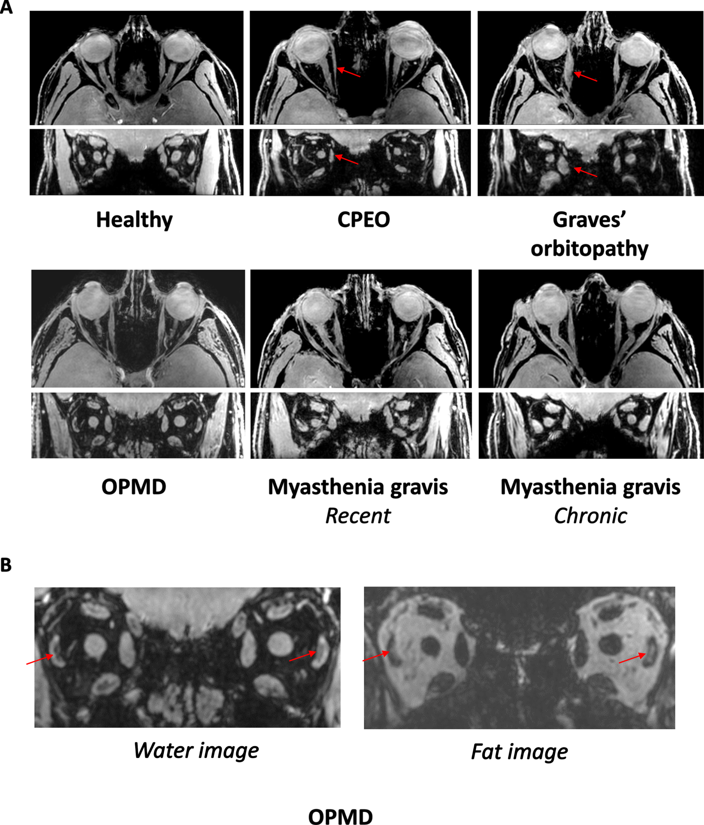 A. MRI scans from the orbit showing the extra-ocular muscles in a healthy control, a chronic progressive external orbitopathy (CPEO) patient, a Graves’ orbitopathy patient, an oculopharyngeal muscular dystrophy (OPMD) patient, a recent myasthenia gravis patient and a chronic myasthenia gravis patient. The axial and coronal water images are shown from a chemical shift based water-fat separation gradient echo scan, a technique to separately image and quantify water and fat. The red arrows indicate the atrophic medial rectus muscle in the CPEO patient and the swollen medial rectus muscle in the Graves’ orbitopathy patient. B. Example of fat replacement of the lateral rectus muscles in an OPMD patient as depicted by the red arrows. On the left the coronal water image and on the right the coronal fat image are shown.
