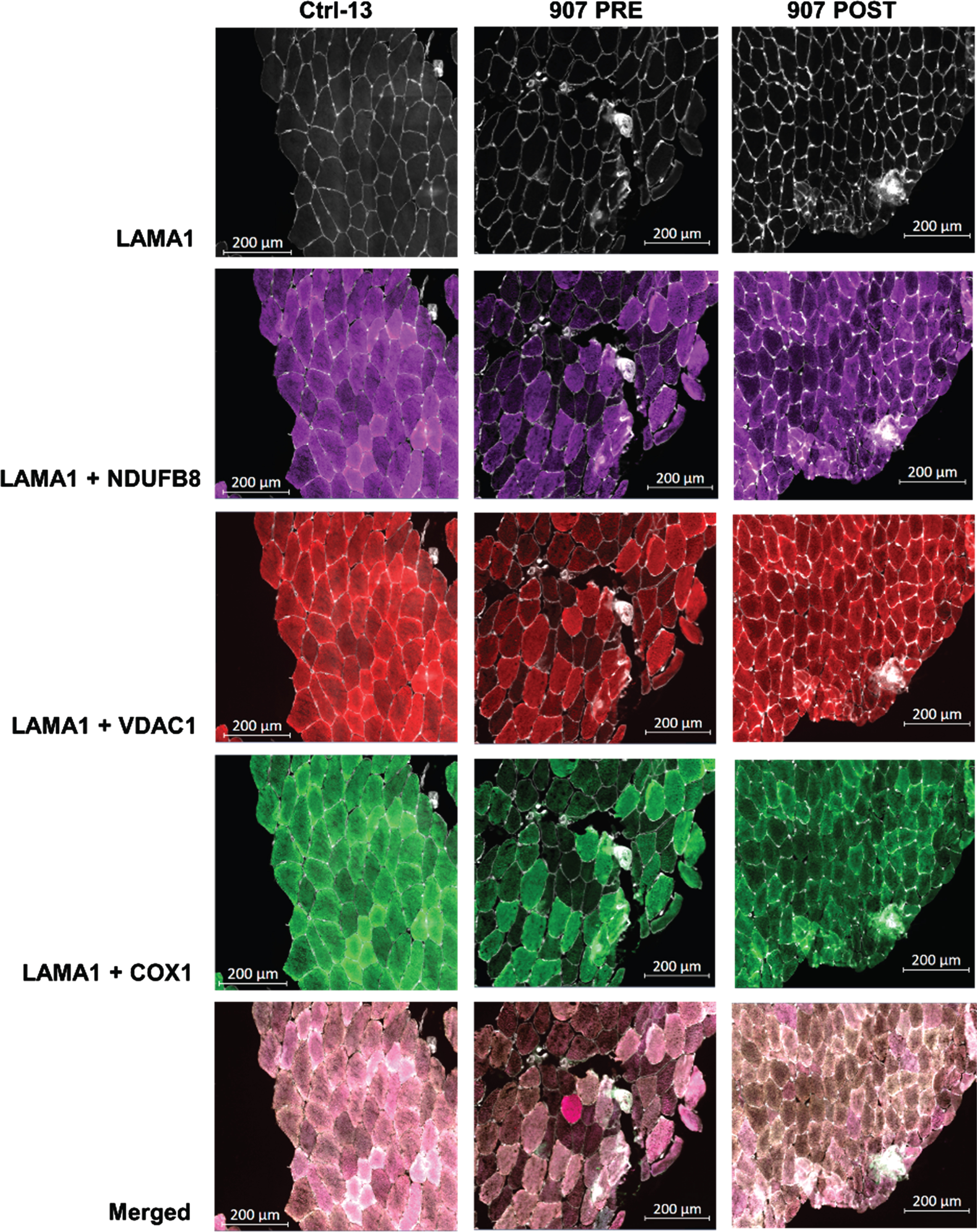 Representative QIF images of control subject, pre- and post-exercise pair from DM1 cohort after resistance exercise training. Representative images of quadruple immunofluorescence staining for LAMA1 (membrane marker), VDAC1 (mitochondrial mass marker), NDUFB8 (complex I marker) and COX1 (complex IV marker) in SKM sections from healthy Ctrl-13, P907 PRE (pre-exercise) and P907 POST (post-exercise) biopsies. The last row is the merge of all channels.