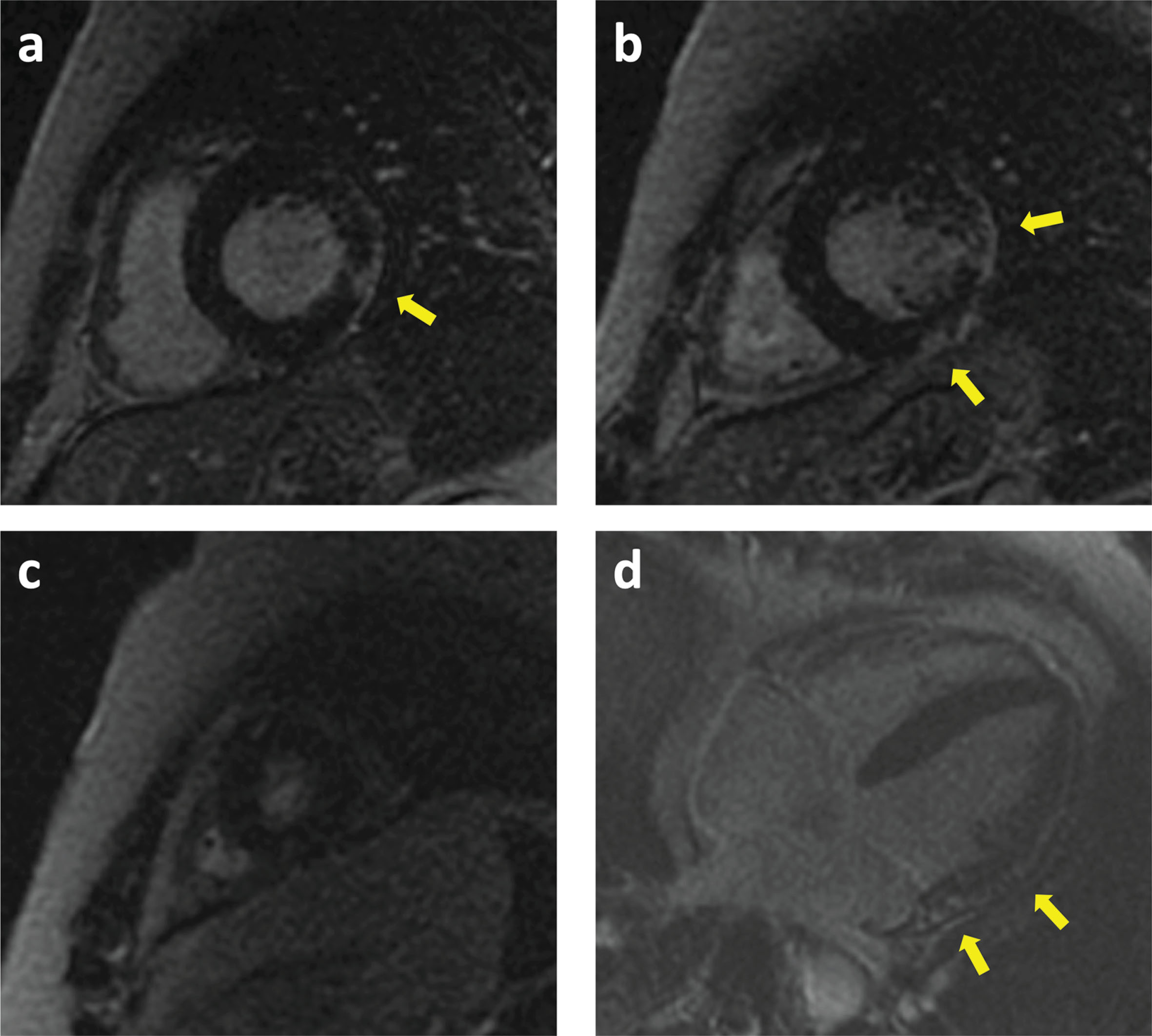 Cardiac MRI of patient 12. Basal (a), mid (b), apical (c) and four chamber (d) views showing Late Gadolinium Enhancement (LGE) in the anterolateral and inferolateral walls (arrows) with a subepicardial pattern.