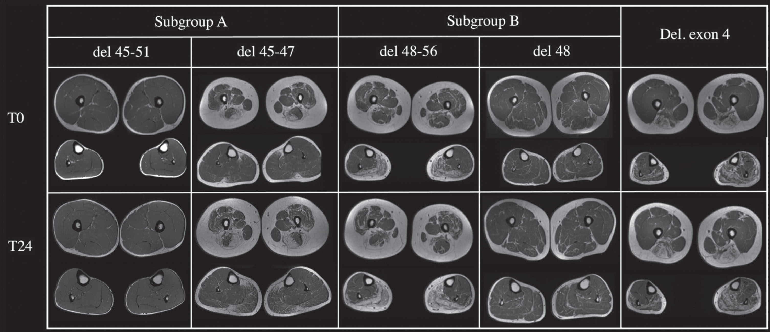 The Figure shows muscle thighs and legs MRI at baseline (T0) and after two years follow up (T24) of five patients with different mutations.