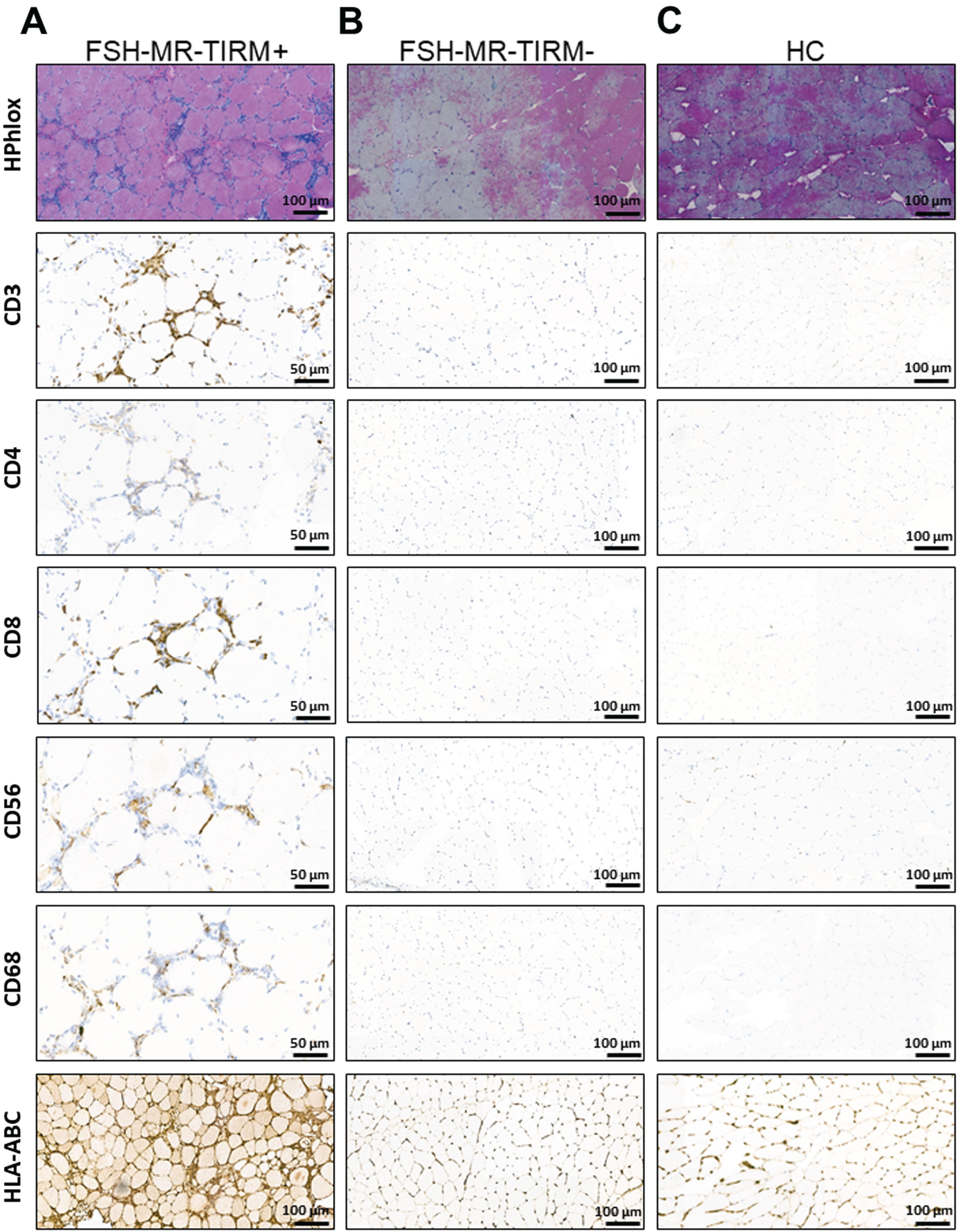 Representative immuno-histological analysis of muscle biopsies. (A) HPhlox staining and immunostaining (CD3, CD4, CD8, CD56, CD68, and HLA-ABC respectively) of serial muscle cryo-sections from a TIRM+ MRI guided muscle biopsy of a 62-year-old patient with FSHD1. The HPhlox staining shows the variability of the fiber size along the section, increased central internal nuclei, the presence of few regenerating fibers, mild local fibrosis and perivascular inflammatory infiltrates. Immunostaining shows that inflammatory infiltrates comprised predominantly CD3, CD8, and CD68 positive cells. CD56 positive cells can be also appreciated at the same inflammatory sites. The staining for HLA-ABC shows evident upregulation. (B) Representative HPhlox and immunostaining (CD3, CD4, CD8, CD56, CD68, and HLA-ABC respectively) of serial muscle cryo-sections from the corresponding TIRM–MRI guided muscle biopsy of the same patient. The HPhlox staining shows normal findings and no muscular dystrophic changes. Along with a normal muscle histology, no inflammatory infiltrates were detected on additional immunostaining and no HLA-ABC upregulation was appreciated. (C) Representative HPhlox and immunostaining (CD3, CD4, CD8, CD56, CD, and HLA-ABC respectively) of serial muscle cryo-sections from a needle muscle biopsy of a sex and age matched healthy control showing normal findings and no inflammation.