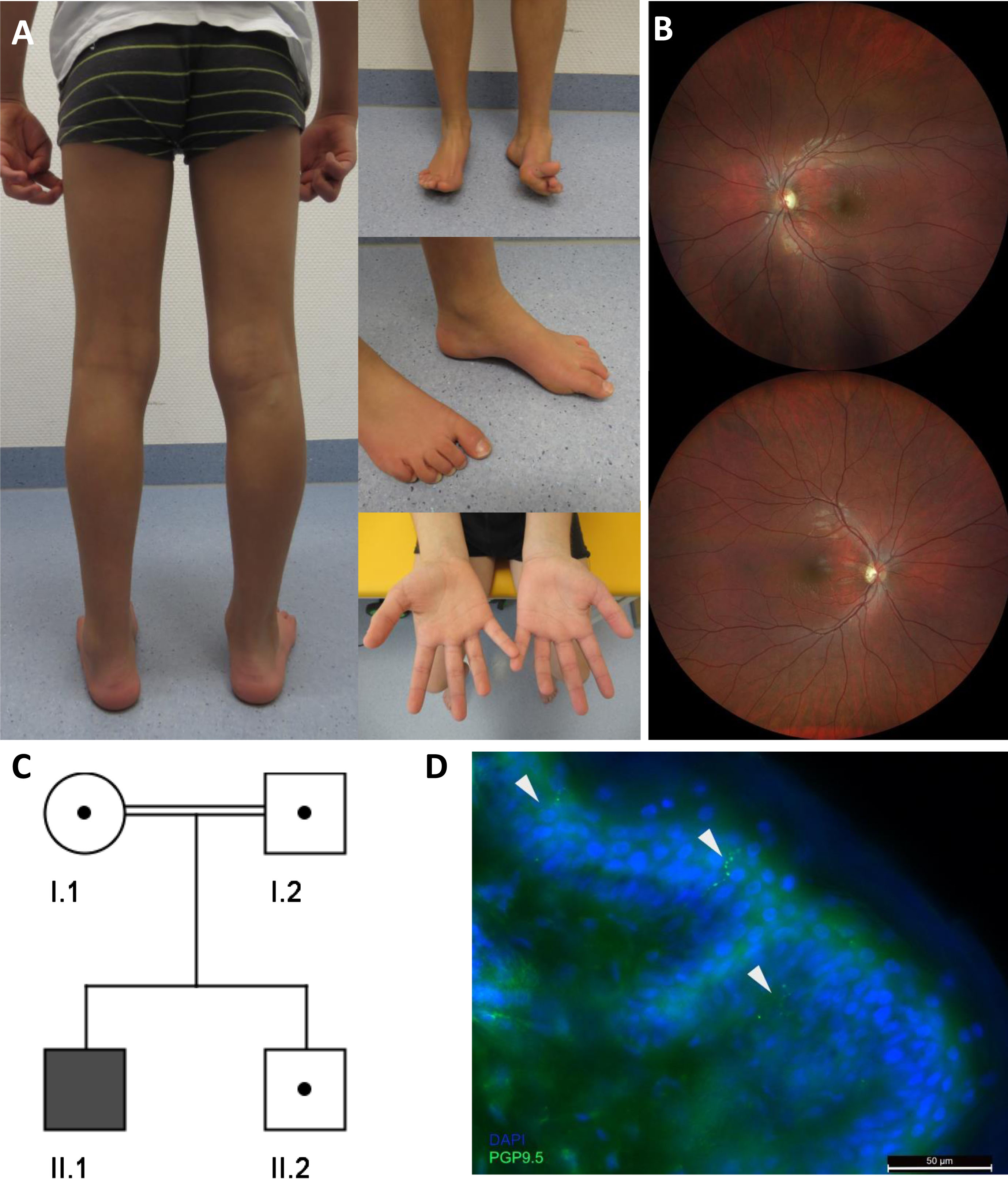 (A) Photographs of the index patient at the age of 9 years illustrate high arched feet (left > right) and reduced ability to lift both forefeet. (B) Ocular fundus showing bilateral partial optic atrophy (left > right). (C) Pedigree chart of the family described in this study. (D) Significant decrease of intraepidermal nerve fiber stain with PGP9.5 (arrows).