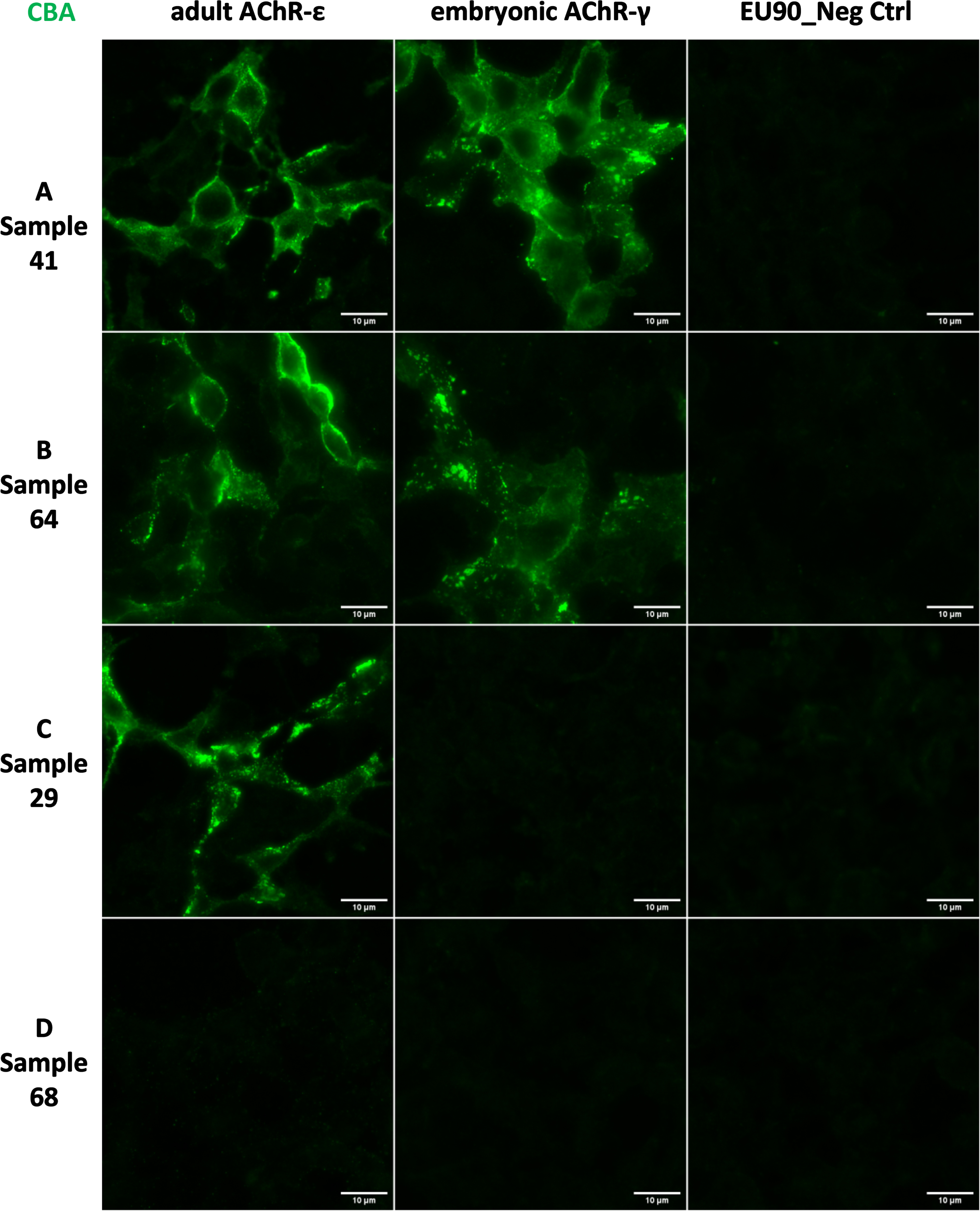 Anti-nAChR reactivity by the fixed Cell-Based Assay (CBA). Indirect Immunofluorescence analysis with EU90 cells expressing adult AChR-ɛ or embryonic AChR-γ. (A and B) Examples of samples with reactivity for adult and embryonic AChR. (C) Example of a sample with reactivity only for adult ɛ. (D) Example of a sample without any reactivity. Scale bars = 10μm.
