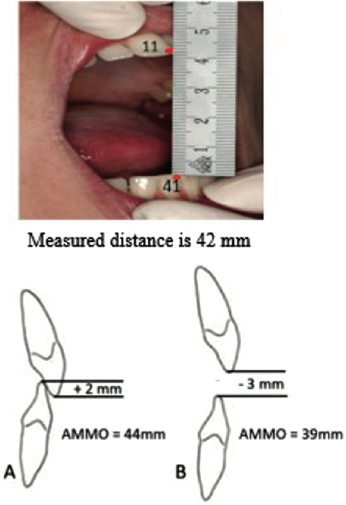 Protocol to measure the maximum mouth opening with a ruler. Verbal instruction: After opening the mouth widely several times the following instruction was given: “open as wide as possible, wider, wider’. Measurement: Ruler from the incisal edge of the right maxillary central incisor tot the incisal edge of the right mandibular central incisor at the midline and measure the distance. Correction for tooth position: Add up the overbite (A) or subtract the open bit (B).