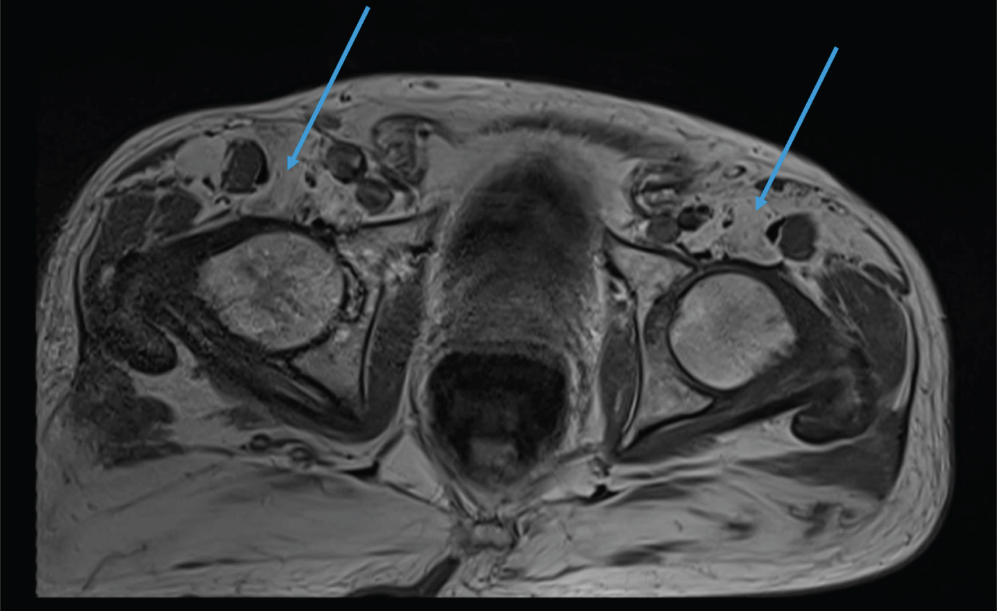 MRI of the pelvis. Complete fatty replacement of the psoas muscles (arrows).