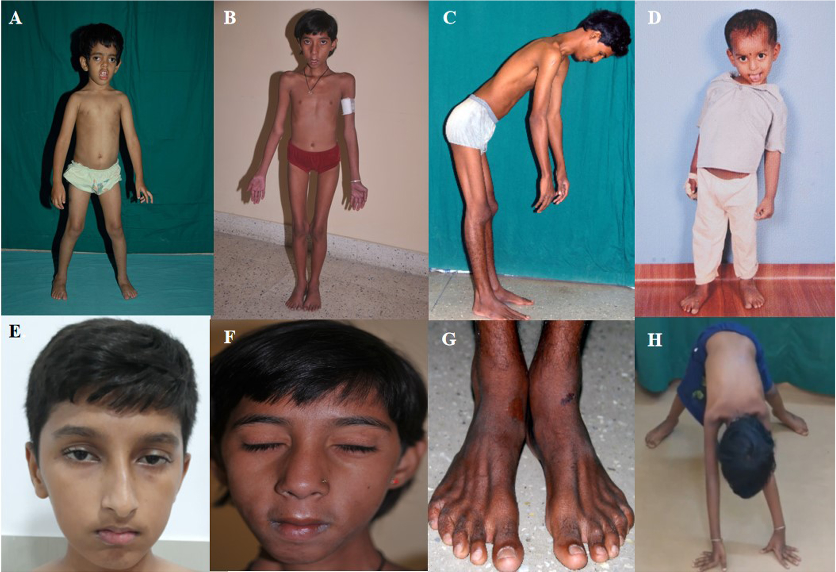 Representative photographs of children with congenital myopathy showing features of – A. dental mal-occlusion and bilateral ptosis (P-14), B: myopathic facies as elongated face and sunken cheeks (P-18), C. rigid spine (P-19), D. skeletal deformity- scoliosis (P-8), E bilateral ptosis (P-28), F. bifacial weakness(P-18), G. wasting of extensor digitorum brevis in both legs (P-19), H. features suggesting proximal lower limb weakness on trying to get up from floor (P-20). (Consent obtained)