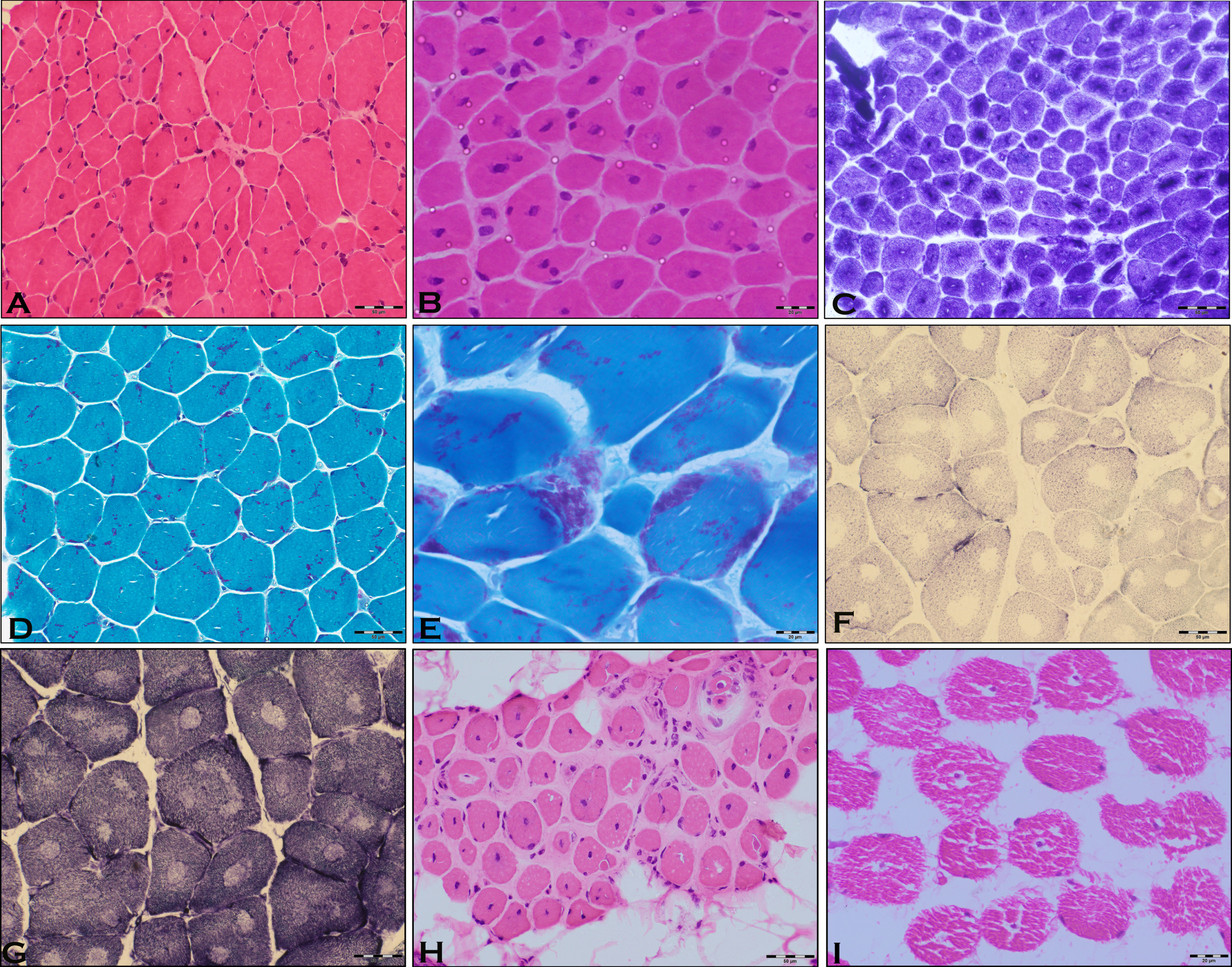 Microphotograph showing transverse section of P-2, centronuclear myopathy with many muscle fibres (>30%) possessing central nuclei (H & E x100) [A, B] and radial staining pattern (NADH × 200) [C]. Microphotograph showing transverse section in P-25, of Nemaline myopathy with many muscle fibres displaying Nemaline rods of variable density, configuration and distribution (MGT × 200) [D]displaying Nemaline rods (black arrow) of variable density, configuration and distribution (MGT × 400) [E]. Microphotograph showing transverse section of P-27, central core myopathy with many muscle fibres displaying central areas (Cores) of absence of oxidative activity (SDH × 200) [F] and (NADH × 200) [G]. Note the type I fibre predominance. Microphotograph showing transverse section in P-15 of centronuclear myopathy with many muscle fibres (>30%) possessing central nuclei. Also observed is the adipocytic infiltration and fibrosis (H & E ×100) [H]. Microphotograph showing transverse section in P-17 of centronuclear myopathy with many muscle fibres (>30%) possessing central nuclei (H & E × 200) [I].