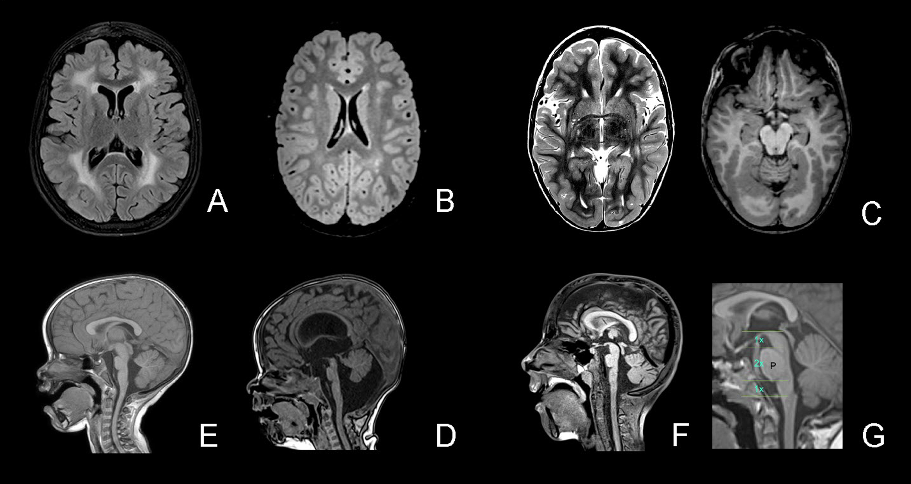 White matter changes and structural abnormalities. Legend. A, White matter changes – diffuse (FLAIR); B, White matter changes – patchy (T2); C, Cobblestone malformation occipital (T2 left and T1 right); D, Brainstem – pons hypoplasia and vermis rotation (T1); E, Pons hypoplasia and large interthalamic adhesion; F, Pons hypoplasia, Midbrain-Pons-Medulla Proportions (ac. Barkovitch); G: normal midbrain-pons-medulla proportions.