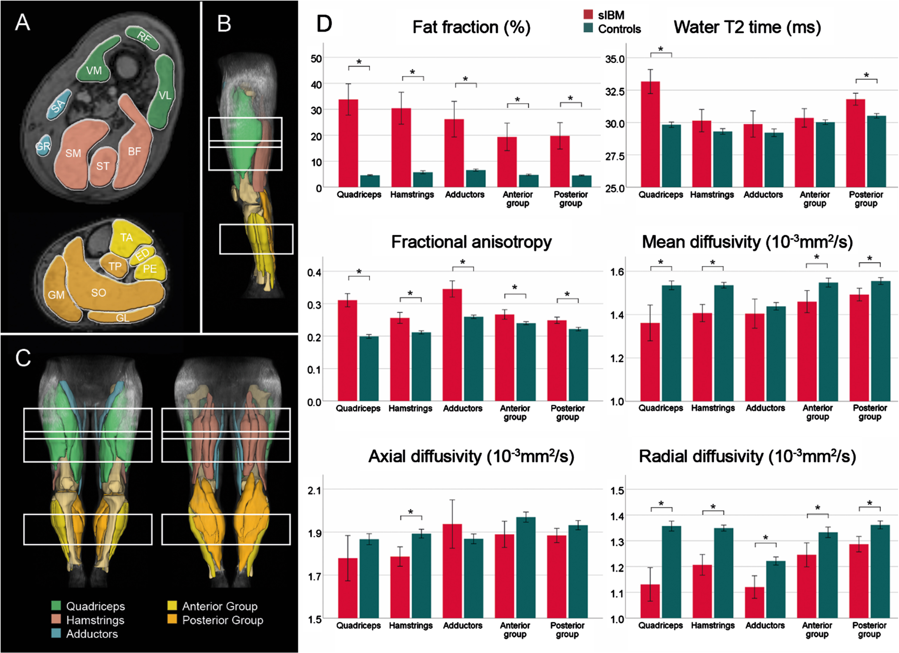 Overview of segmented muscles and corresponding muscle groups in a representative participant (A – cross-sectional; B – side view, C – front and back view). Bar plots show mean qMRI metrics for patients with sporadic inclusion body myositis (sIBM) and control group (D). The lines show the 95% -interval of confidence. *adjusted p < 0.05. BF = biceps femoris; ED = extensor digitorum longus; GM = gastrocnemius medialis; GL = gastrocnemius lateralis; GR = gracilis; PE = peroneal group; RF = rectus femoris; SA = sartorius; SO = soleus; SM = semimembranosus; ST = semitendinosus; TA = tibialis anterior; TP = tibialis posterior; VL = vastus lateralis; VM = vastus medialis.