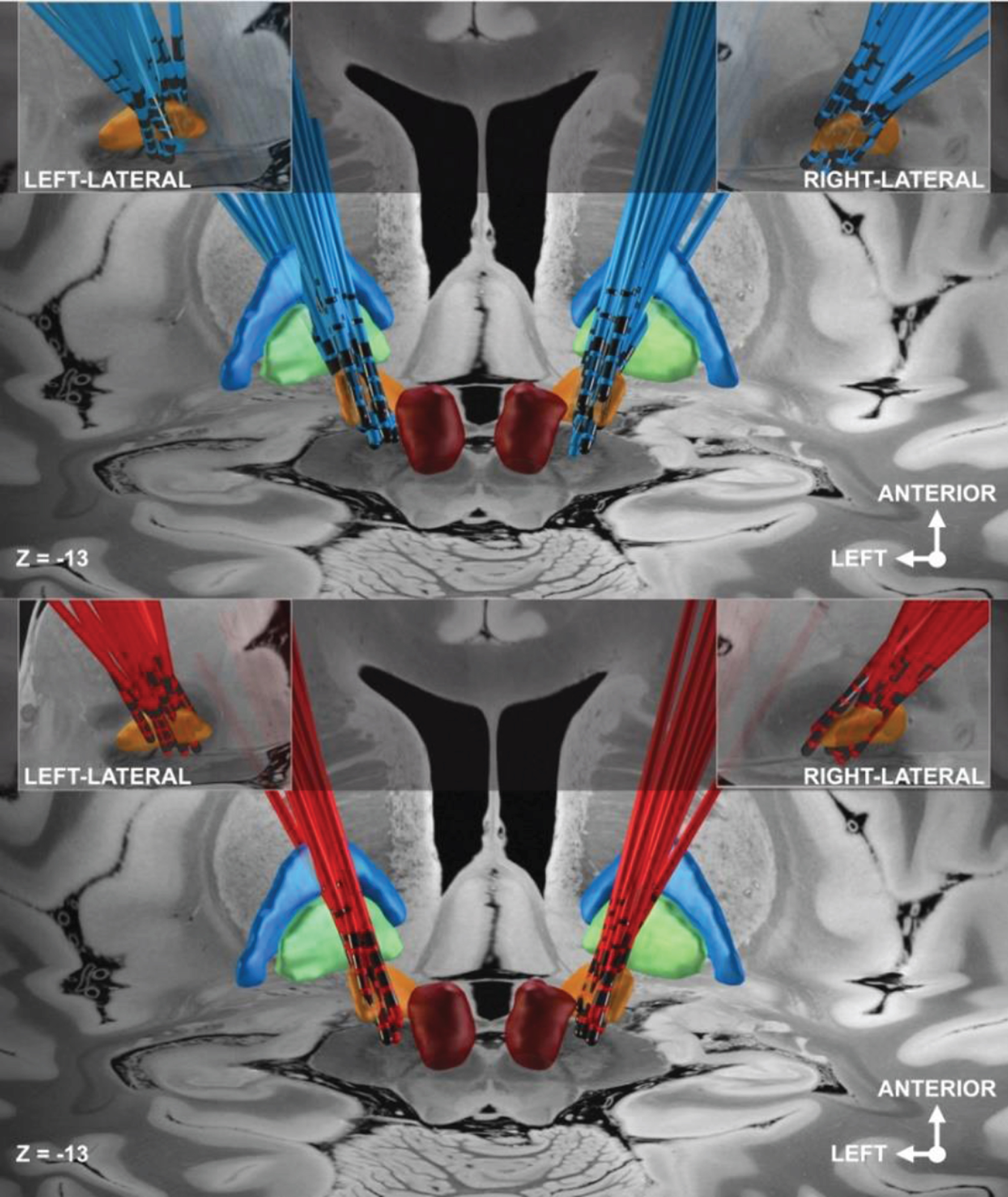 Visualization of electrode locations of the POD– (blue electrodes) and POD+ group (red electrodes). Dark red: red nucleus; orange: STN; green: Globus pallidus internus (GPi); blue: Globus pallidus externus (GPe).