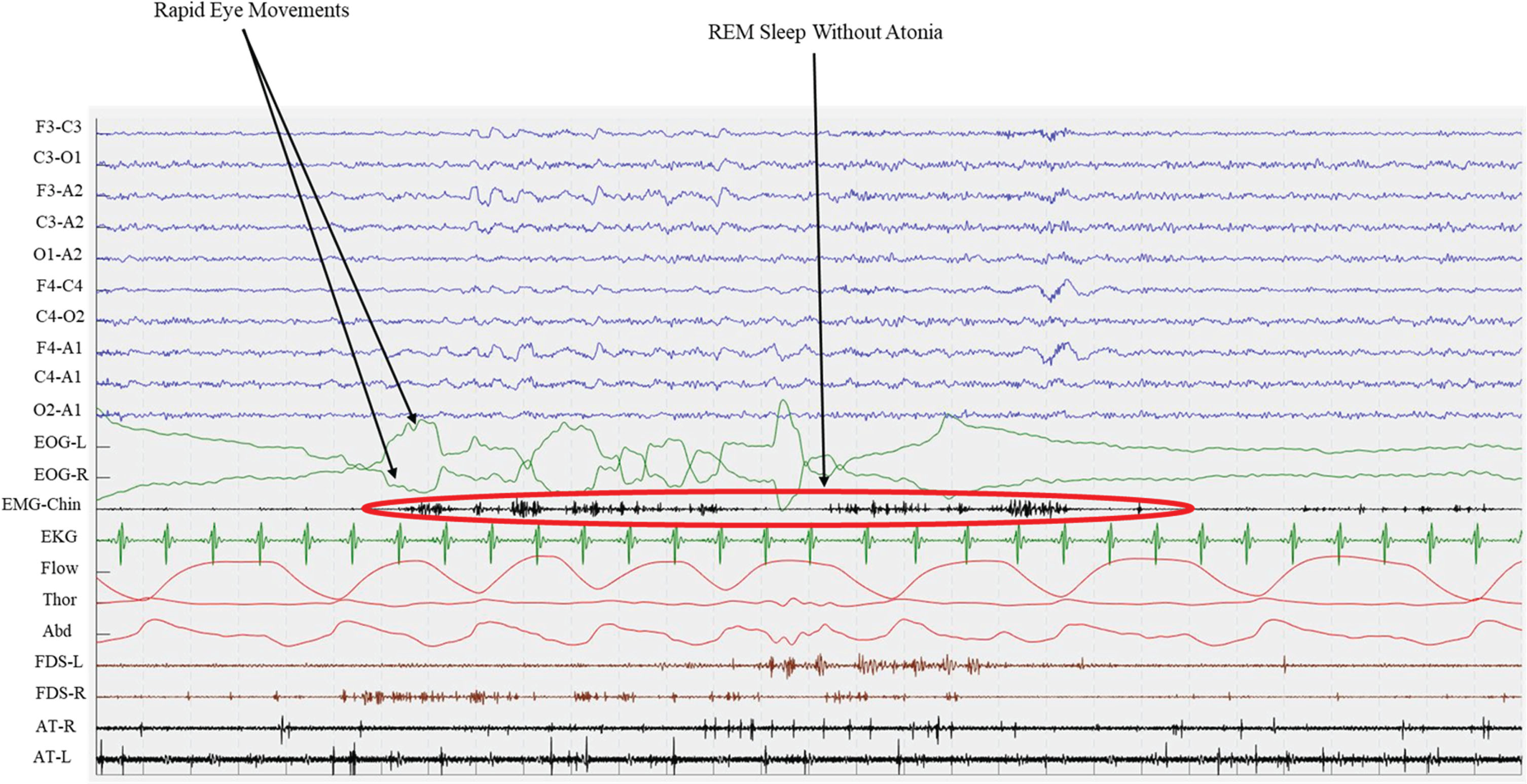 Polysomnographic epoch of an iRBD patients. Green lines (EOG-L and EOG-R) shows Rapid Eye Movements both for left and right eyes, while EMG records chin muscle activity. This recording shows the presence of REM Sleep Without Atonia (RWA) during REM sleep. EOG, electro-oculogram; EMG, electro-myogram; EKG, electro-cardiogram; Flow, oro-nasal air flow; Thor, thoracic effort; Abd, abdominal effort; FDS, flexor digitorum superficialis; AT, anterior tibialis; L, left; R, right.