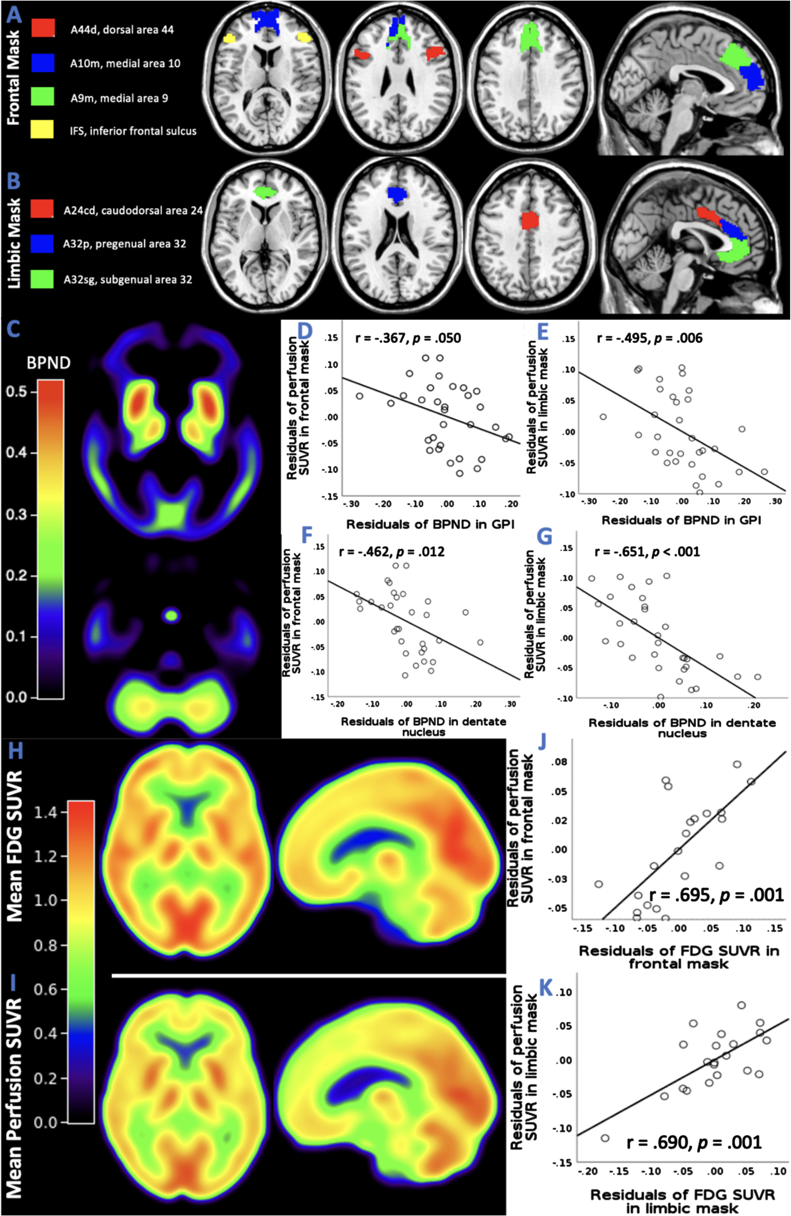
Link between subcortical tau and cortical dysfunction in PSP. A frontal mask A) and a limbic mask B) were created by including regions of the Brainnetome atlas,10 where patients with PSP had significant hypoperfusion in previous work.6 C) Mean BPND maps in the PSP cohort showing a typical pattern of tau depositions in subcortical regions. D-G) Partial correlation analyses between BPND in GPI and dentate and perfusion SUVR in frontal and limbic mask corrected for age, sex and BPND in respective cortical mask. For visualization, scatterplots of the residuals of BPND and SUVR in the corresponding region were created. H) Mean perfusion SUVR map of [18F]PI-2620. I) Mean SUVR map of [18F]FDG. SUVR were calculated with the cerebellum excluding the dentate nucleus as reference region. J, K) Partial correlation analyses between perfusion SUVR and FDG SUVR in frontal and limbic mask corrected for age and sex. For visualization, scatterplots of the residuals of PDG and perfusion in the corresponding region were created.