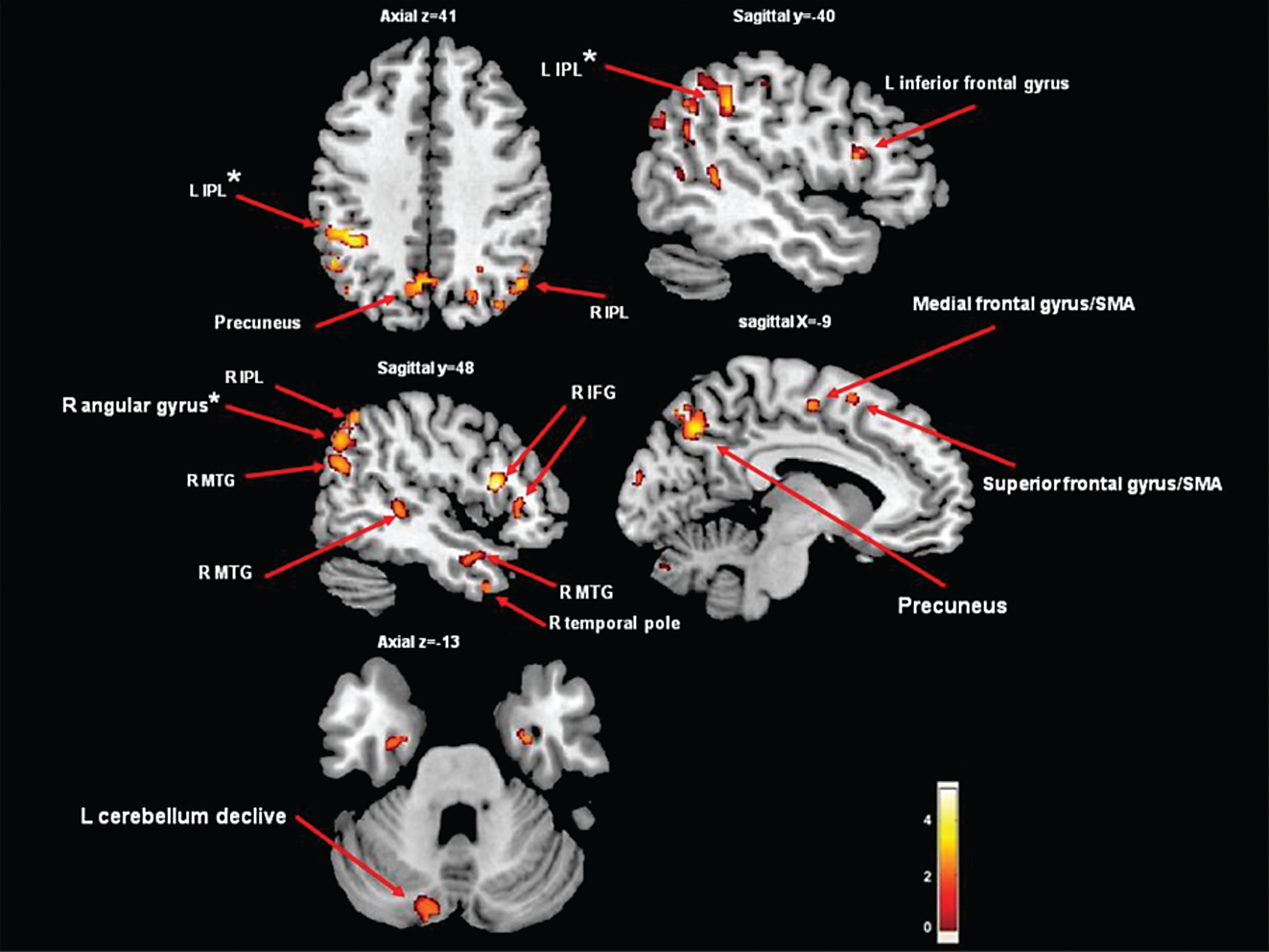 Areas of gray matter atrophy derived from a voxel-based morphometric direct comparison between PD patients with FOG (n = 22) and PD patients without FOG (n = 22). The GM maps were analyzed using analysis of variance (ANOVA) as implemented in SPM5. The model was adjusted for age and disease duration. The results are superimposed in representative sagittal and axial sections of a customized gray matter template, at a threshold of p <  0.005, uncorrected cluster size >50.  *indicates p <  0.05, cluster level corrected. Note that if we applied FWE correction on the contrasts maps, the group differences were no longer significant. Significantly lower values of GM in the freezers compared to the non-freezers were observed in the precuneus, frontal gyrus/supplementary motor area, cerebellum declive and middle temporal gyrus (p <  0.005, uncorrected). In addition, in the left IPL and the right angular gyrus, significant differences were found when correcting for multiple comparisons (p <  0.015, cluster level corrected). IFG = inferior frontal gyrus; SMA = supplementary motor area; IPL = inferior parietal lobe; MTG = middle temporal gyrus.