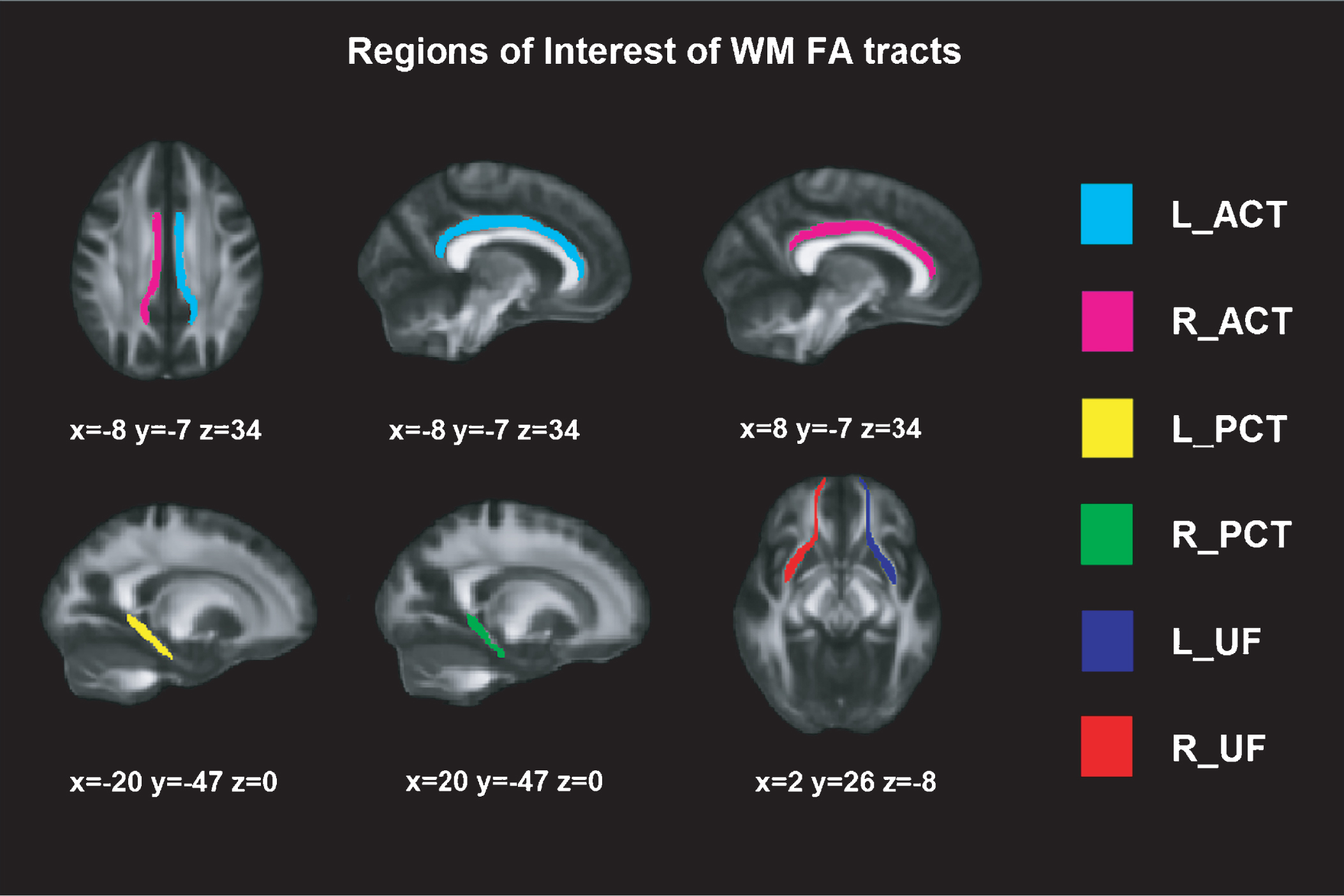 Regions of Interest of WM FA tracts. Montreal Neurological Institutes (MNI) template coordinates based on JHU WM Tractography Atlas. WM = White Matter; FA = Fractional Anisotropy; L = Left; R = Right; ACT = Anterior Cingulate Tract; PCT = Posterior Cingulate Tract; UF = Uncinate Fasciculus.