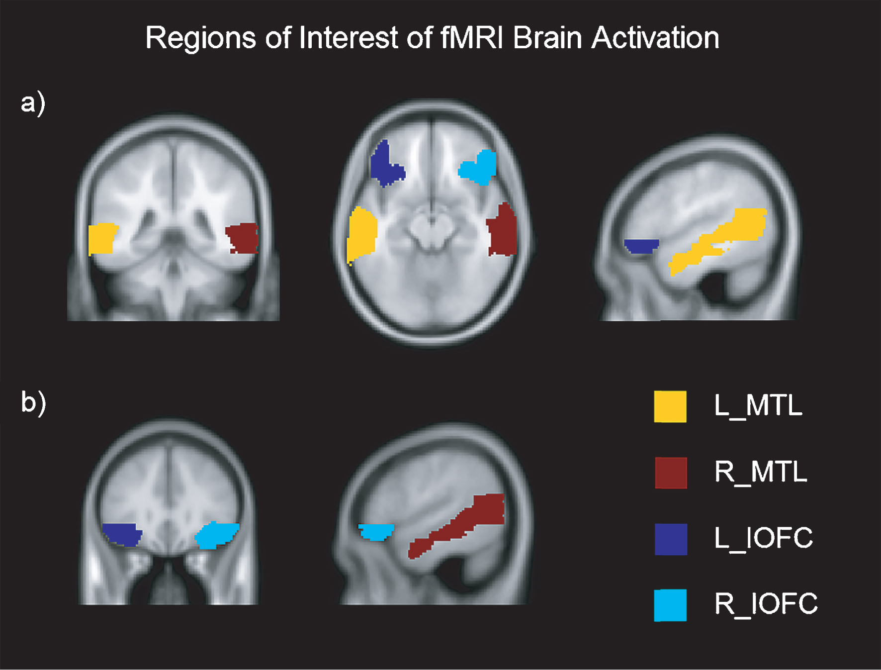 Regions of Interest of fMRI brain activation in axial, coronal and sagittal view. Montreal Neurological Institutes (MNI) template coordinates for a): x = –50.2 y = –40.8 z = –13.5. MNI for b): x = 53.7 y = 31 z = –12.5. L = Left; R = Right; MTL = Medial Temporal Lobe; IOFC = Inferior Orbitofrontal Cortex.