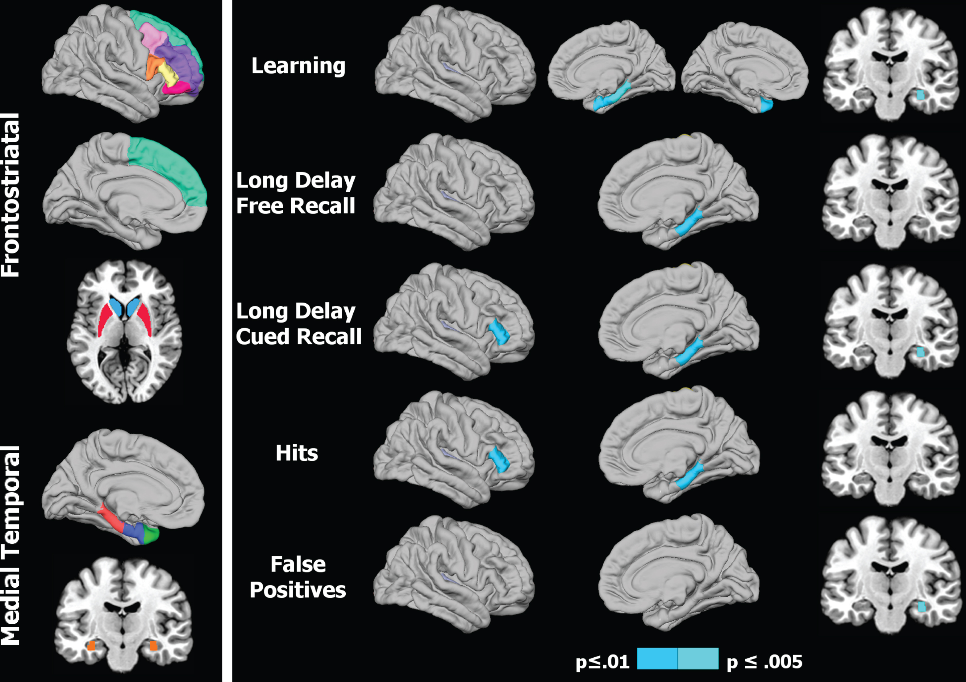 Regional volumes of interest and their association with memory in Parkinson’s patients. 1) Left panel: Colored areas designate regions of interest (ROI) in the frontostriatal and medial temporal systems. ROIs on sagittal surfaces are displayed for one hemisphere, but were analyzed for homologous areas of both hemispheres. The caudate/putamen and the hippocampus are respectively shown on axial and coronal views. 2) Right panel: Right hemisphere cortical (lateral/medial sagittal surfaces) and hippocampus (coronal view) volumes that significantly correlated with various memory measures. For CVLT learning (top row), the left hemisphere medial surface displays the significant correlation with the temporal pole. The p value for correlation coefficients is designated by the color bar; p≤0.01 (dark blue) and p≤0.005 (light blue).