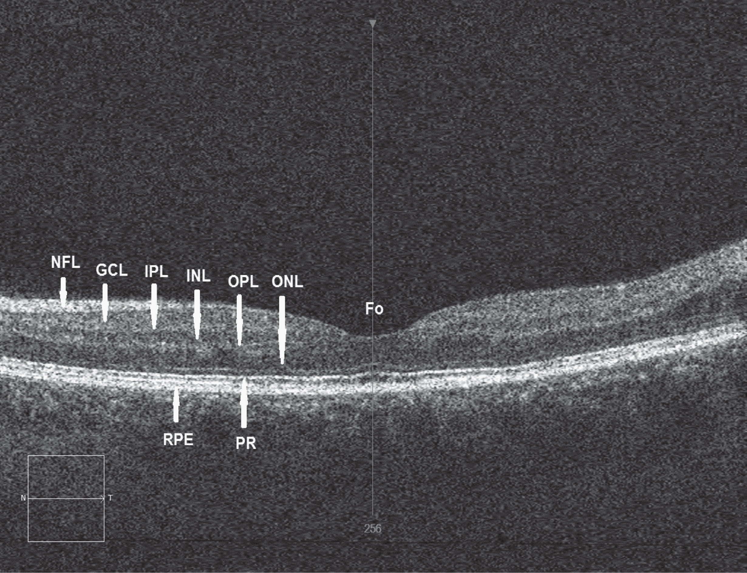 Retinal image of a normal control subject using optical coherence tomography (OCT) showing the various functional layers: Fo = Location of fovea, NFL = Nerve fibre layer, GCL = Ganglion cell layer, IPL = Inner plexiform layer, INL = Inner nuclear layer, OPL = Outer plexiform layer, ONL = Outer nuclear layer, RPE = Retinal pigment epithelium, PR = Photoreceptor layer, N = Nasal direction, T = Temporal direction. A specific thinning of INL in the parafoveal region has been recorded in Parkinson’s disease (PD). (Image courtesy Dr R Heitmar, Aston University)