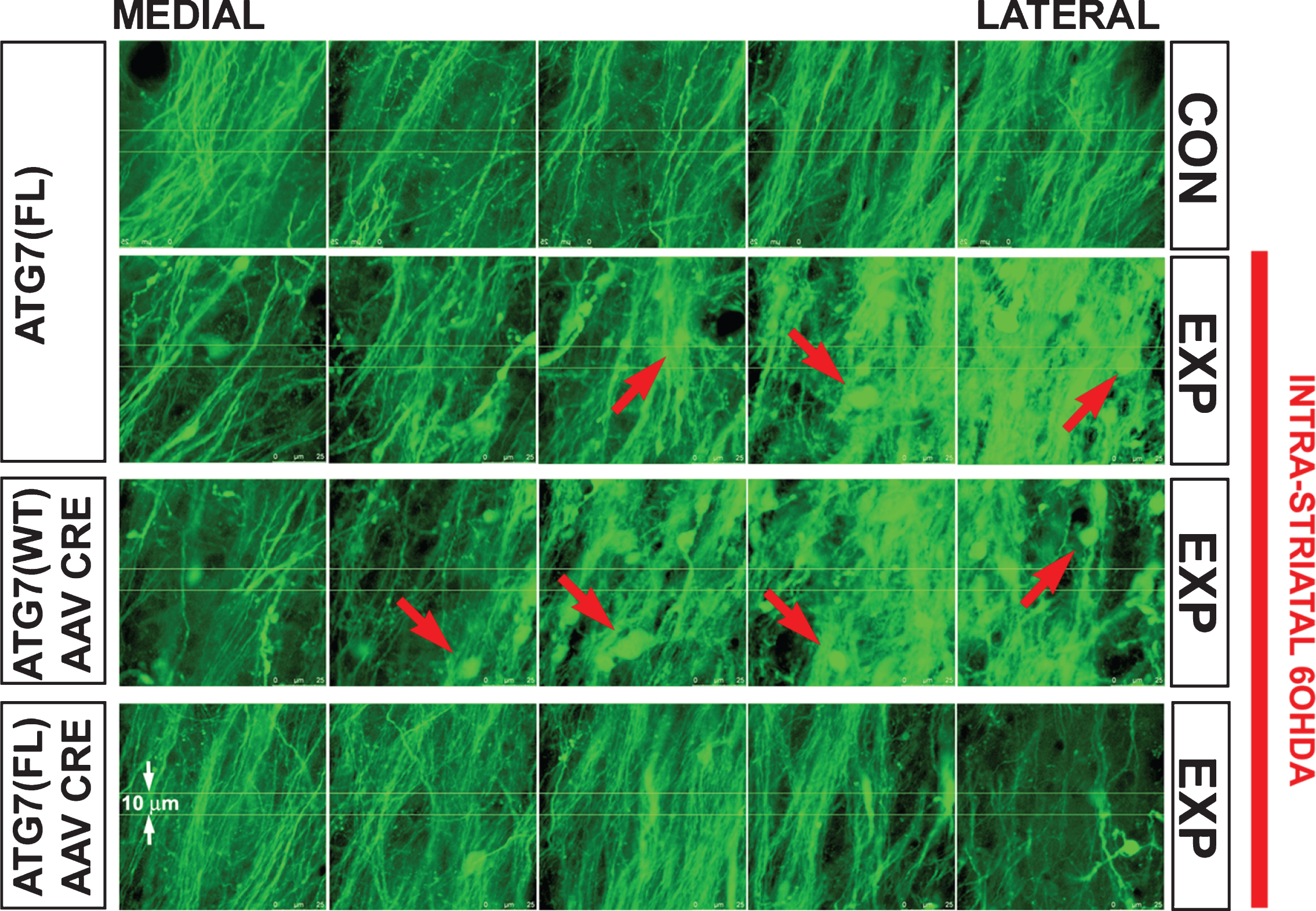 Each panel shows nigrostriatal axons in the MFB visualized by confocal microscopy in TH-GFP mice. Following deletion of Atg7, axons of SNpc dopamine neurons are resistant to retrograde axon degeneration. In the absence of AAV Cre injection, Atg7fl/fl:TH-GFP mice show a loss of MFB dopaminergic axons, and the appearance of axonal spheroid pathology (red arrows) following unilateral 6OHDA injection. Atg7wt/wt:TH-GFP mice injected with AAV Cre show a similar axon loss and pathology. However, following injection of AAV Cre, Atg7fl/fl:TH-GFP mice show minimal axon loss and pathology following 6OHDA injection. Atg7fl/fl:TH-GFP mice without AAV Cre (n = 5) and Atg7wt/wt:TH-GFP mice given AAV Cre (n = 6) show a mean loss of 31 (or 32% ) and 32 (or 34% ) MFB axons respectively, whereas Atg7fl/fl:TH-GFP mice treated with AAV Cre (n = 6) show a mean loss of only 5 (or 5% ) (p <  0.001, ANOVA).
