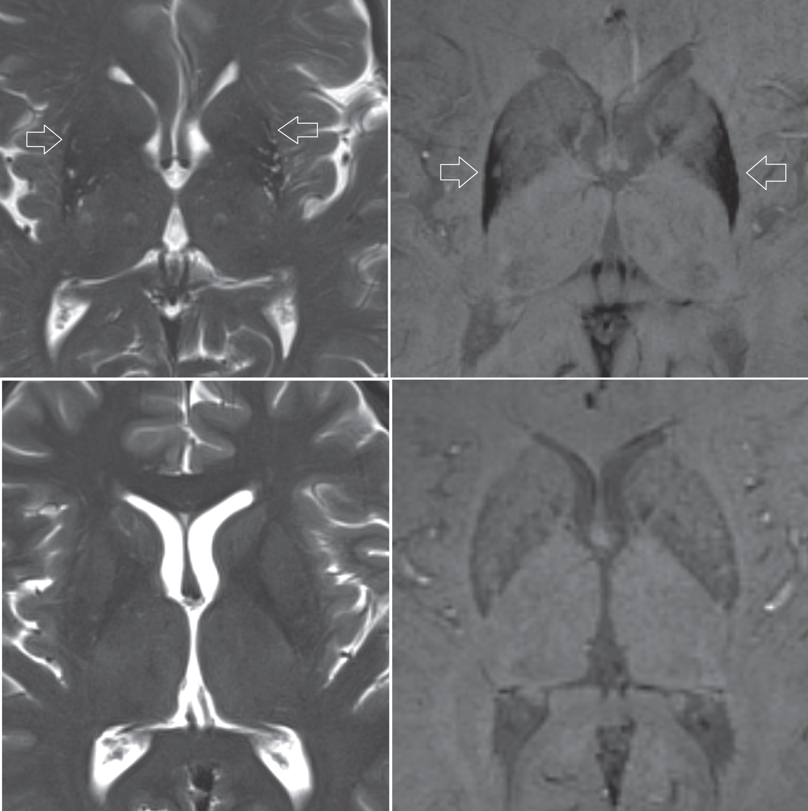 Upper row, patient diagnosed with MSA. Atrophy of the putamen can be depicted on the T2-weighted sequence (left image), while pronounced susceptibility changes of the putamen is better seen on a SWI sequence (right image). Lower row, T2-weighted and SWI images of a healthy control subject for comparison.
