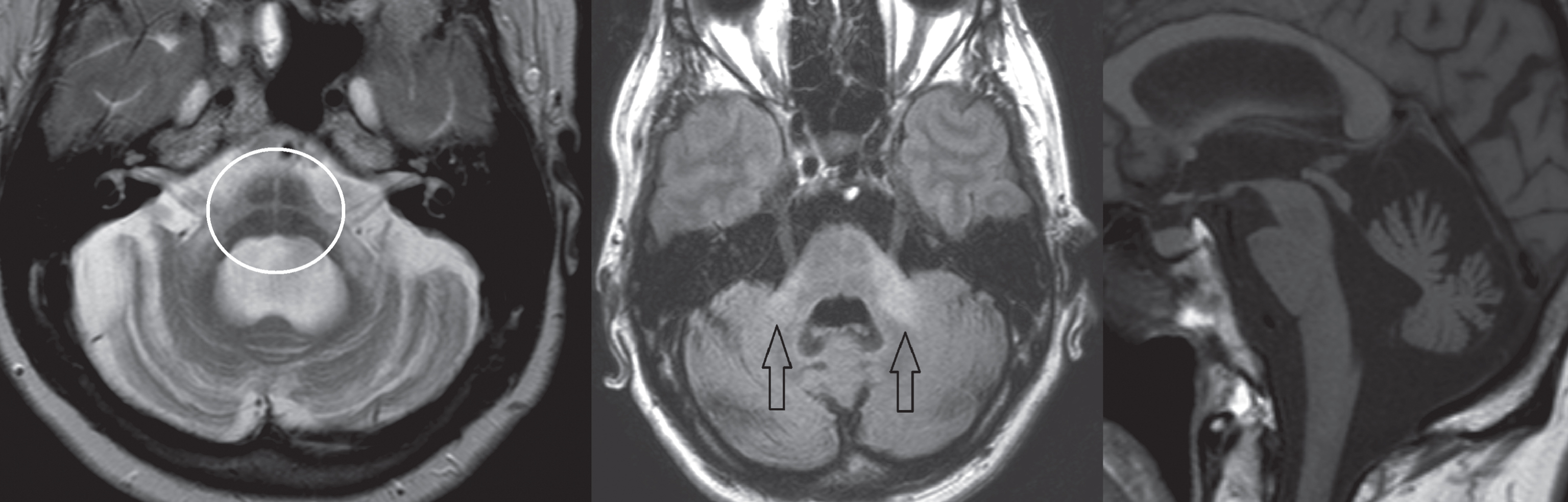 Subject diagnosed with the cerebellar form of MSA. Left image, T2-weighted transversal sequence demonstrating pontine atrophy with the ‘hot cross bun’ sign (encircled). Middle image, FLAIR hyper-intense signal intensity changes of the middle cerebellar peduncles (arrows). Right image, T1-weighted sagittal plane demonstrating pontocerebellar atrophy.