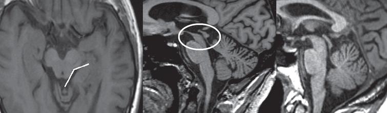 T1-weighted images in transversal (left image) and sagittal (middle image) planes demonstrating atrophy of the midbrain, also referred to as the ‘morning glory’ sign and ‘hummingbird’ sign. The subject was diagnosed with PSP. Right image, T1-weighted sagittal plane of a healthy subject for comparison.
