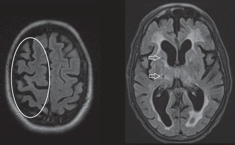 Axial T2 FLAIR sequences. Left image, asymmetrical cortical atrophy (encircled) in a patient with corticobasal syndrome. Right image, hyperintense white matter changes and lacunar infarction (arrows) in a patient diagnosed with vascular parkinsonism.