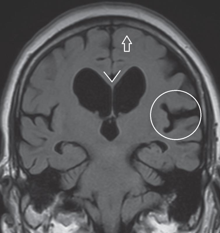 Coronal FLAIR image in a patient diagnosed 
with normal pressure hydrocephalus. Pronounced dilatation of the lateral ventricles and dilation of the Sylvian 
fissure (encircled). Typically, there is no sulcal widening at the vertex (arrow). A decreased corpus 
callosum 
angle (<80°) can distinguish normal pressure hydrocephalus from ex-vacuo venticulomegaly.