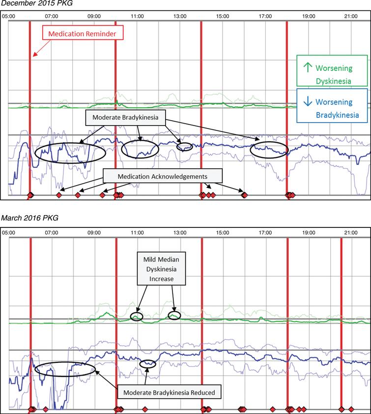 Patient No 13 December 2015 and March 2016 PKG. PKG Summary Plot depicts data from recording day aligned to the time of day. It shows when reminders were given (vertical red lines), the median DKS (heavy green line) and median BKS (heavy blue line) and their corresponding 25th and 75th percentiles plotted against time of day.