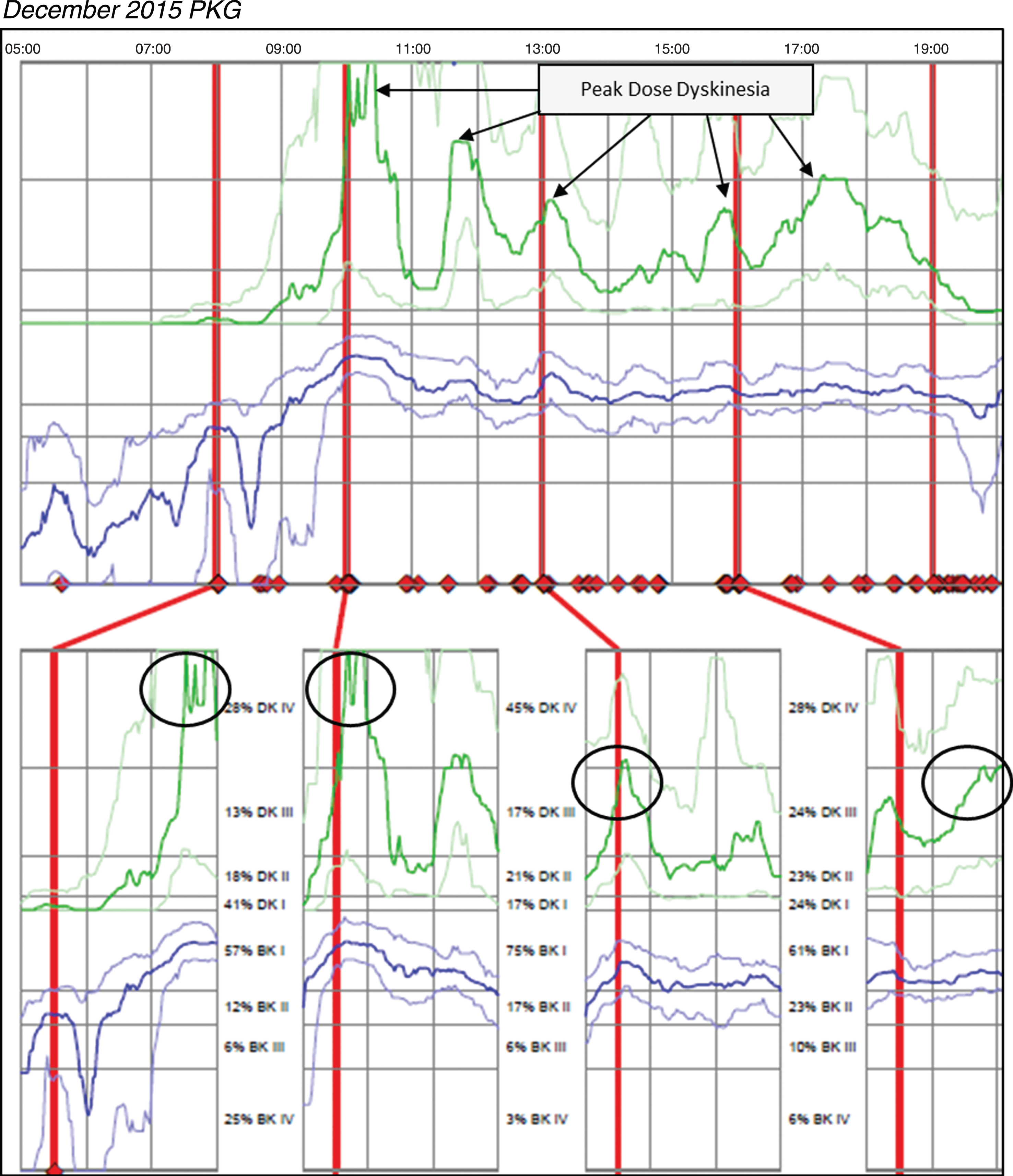 Patient 145 December 2015 PKG: PKG Summary Plot depicts peak dose dyskinesia. Top Image - PKG Summary Plot: Depicts data from recording day aligned to the time of day. It shows when medication reminders were given (vertical red lines), the median DKS (heavy green line) and median BKS (heavy blue line) and their corresponding 25th and 75th percentiles plotted against time of day. Bottom Image - PKG Dose Response Curves: Depicts data from recording day aligned to the time of medication acknowledgement for each individual dose. Programmed medication doses are depicted by vertical red lines. Also illustrated are the median DKS (heavy green line) and median BKS (heavy blue line) and their corresponding 25th and 75th percentiles plotted against time of day.
