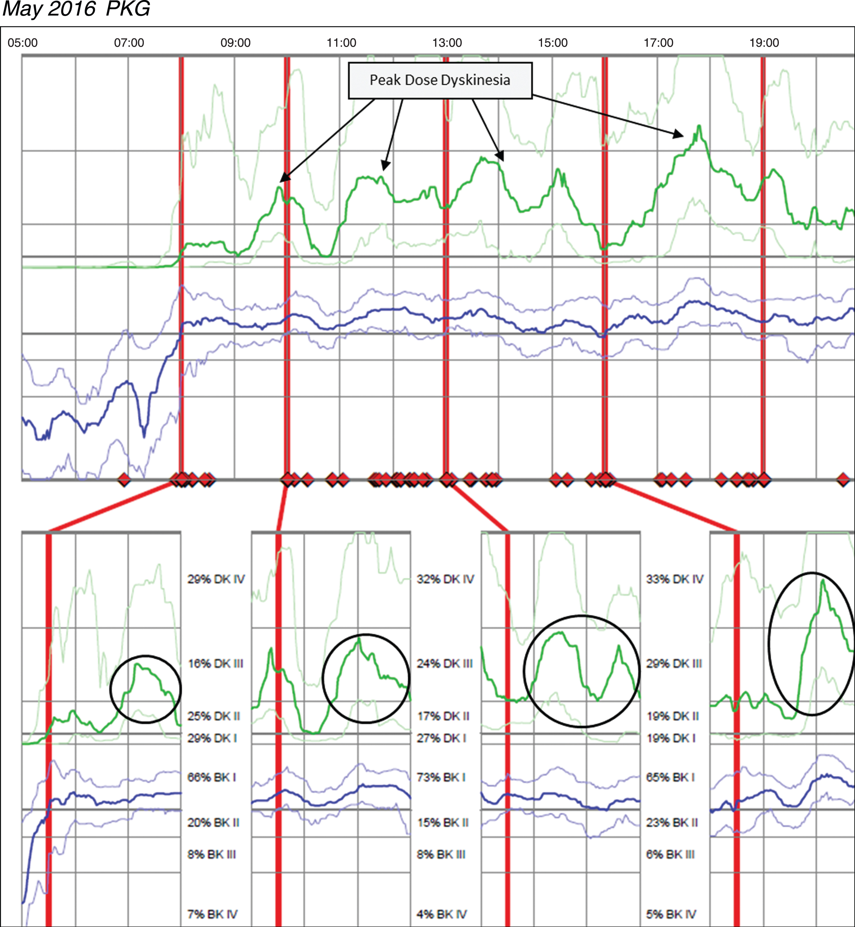 Patient 145 May 2016 PKG. PKG Summary Plot depicts peak dose dyskinesia. Top Image - PKG Summary Plot: Depicts data from all recording day aligned to the time of day. It shows when reminders were given (vertical red lines), the median DKS (heavy green line) and median BKS (heavy blue line) and their corresponding 25th and 75th percentiles plotted against time of day. Bottom Image - PKG Dose Response Curves: Depicts data from recording day aligned to the time of medication acknowledgement for each individual dose. Programmed medication doses are depicted by vertical red lines. Also illustrated are the median DKS (heavy green line) and median BKS (heavy blue line) and their corresponding 25th and 75th percentiles plotted against time of day.