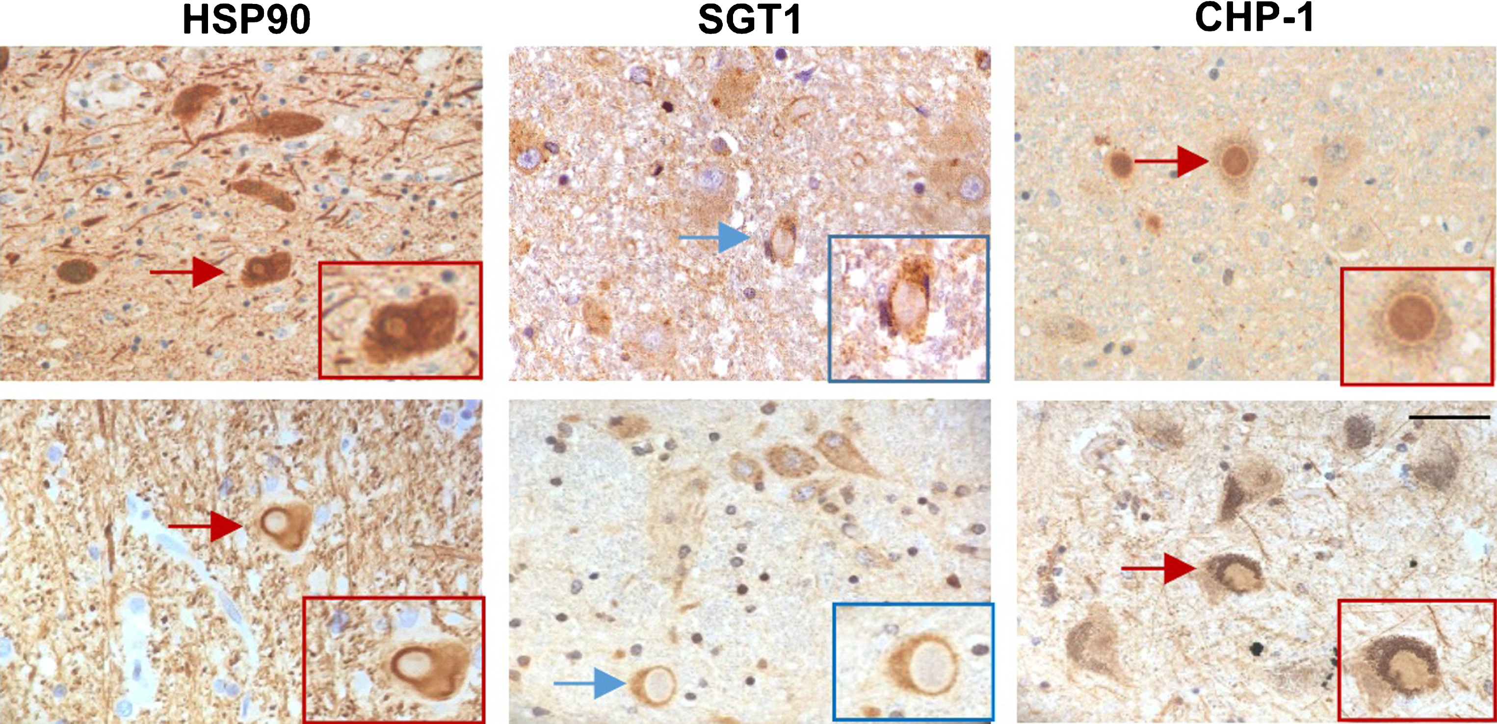 Localization of HSP90, SGT1 and CHP-1 in Lewy bodies in the substantia nigra of PD (upper panel) and DLB brain (lower panel). Scale bar is 50μm.