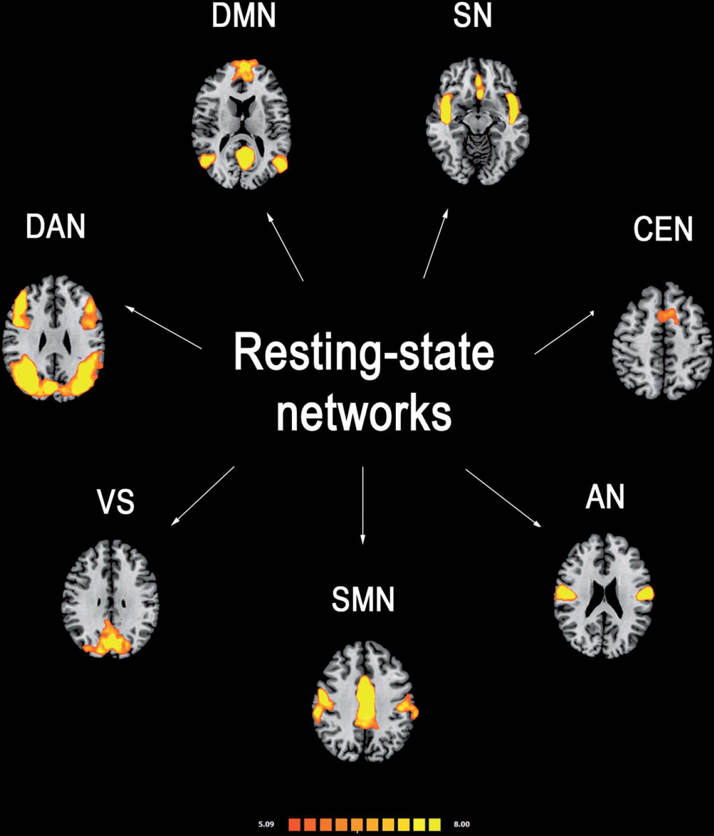 Most reported resting-state functional connectivity networks in healthy controls. Mean resting-state functional MRI imaging networks shown in axial view and three-dimensional reconstructions (p < 0.05 corrected). Colors represent percentage BOLD signal change, overlaid on the average anatomic images in standard space. DMN, default-mode network; SN, salience network; CEN, central executive network; DAN, dorsal attention network; SMN, sensorimotor network; VS, visual network; AN, auditory network.
