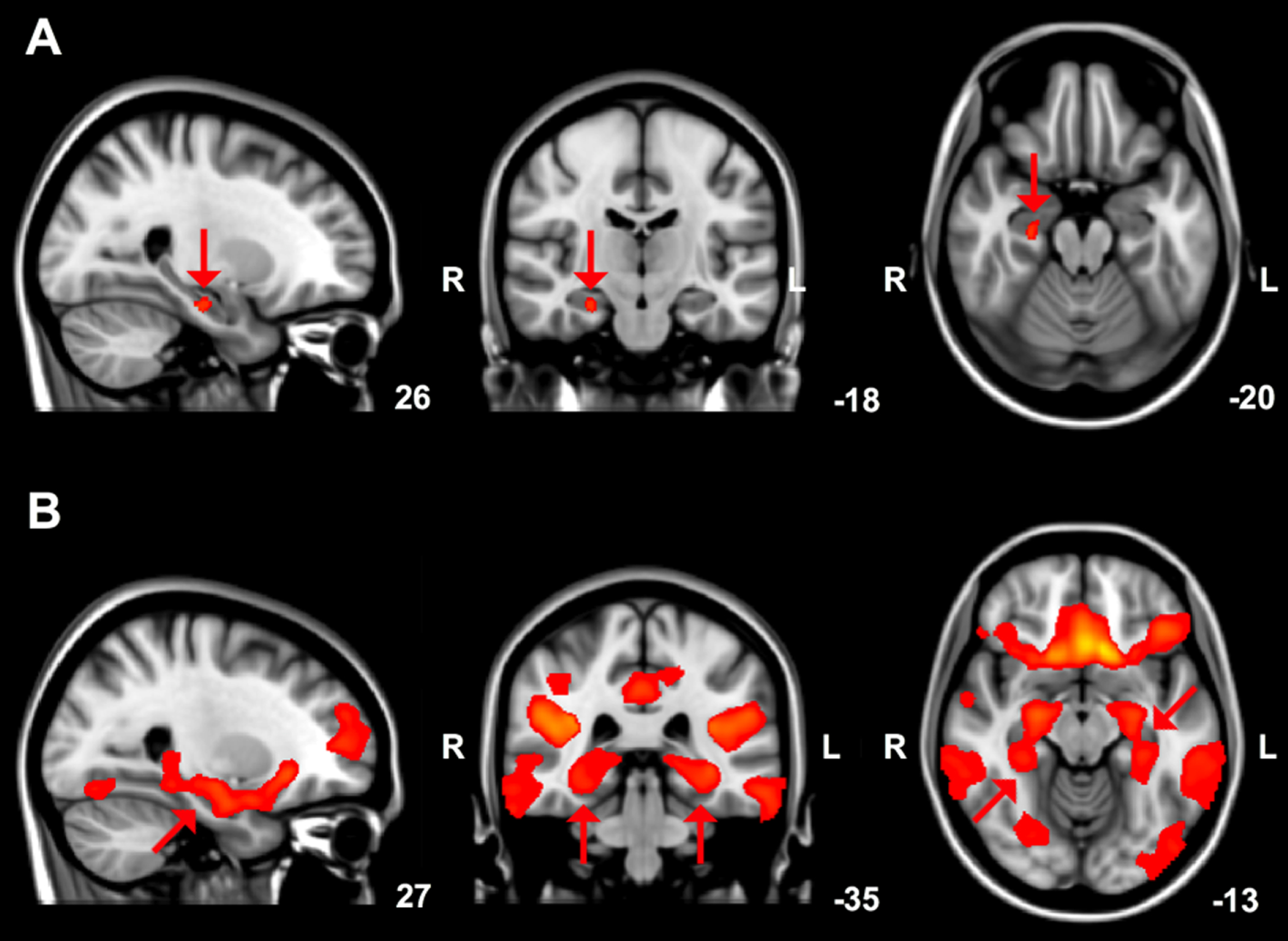 A) Brain areas showing reduced (arrows) grey matter volume in DLB compared to PD patients, overlaid on the MNI standard cerebral image with accompanying coordinates. Results with a threshold-free cluster enhancement (TFCE) family-wise error corrected p-value < 0.05 are shown. B) Grey matter structural covariance posterior cingulate cortex network, overlaid on the most informative slices of the MNI standard cerebral image with accompanying coordinates. Arrows indicate the parahippocampal gyrus and hippocampus.